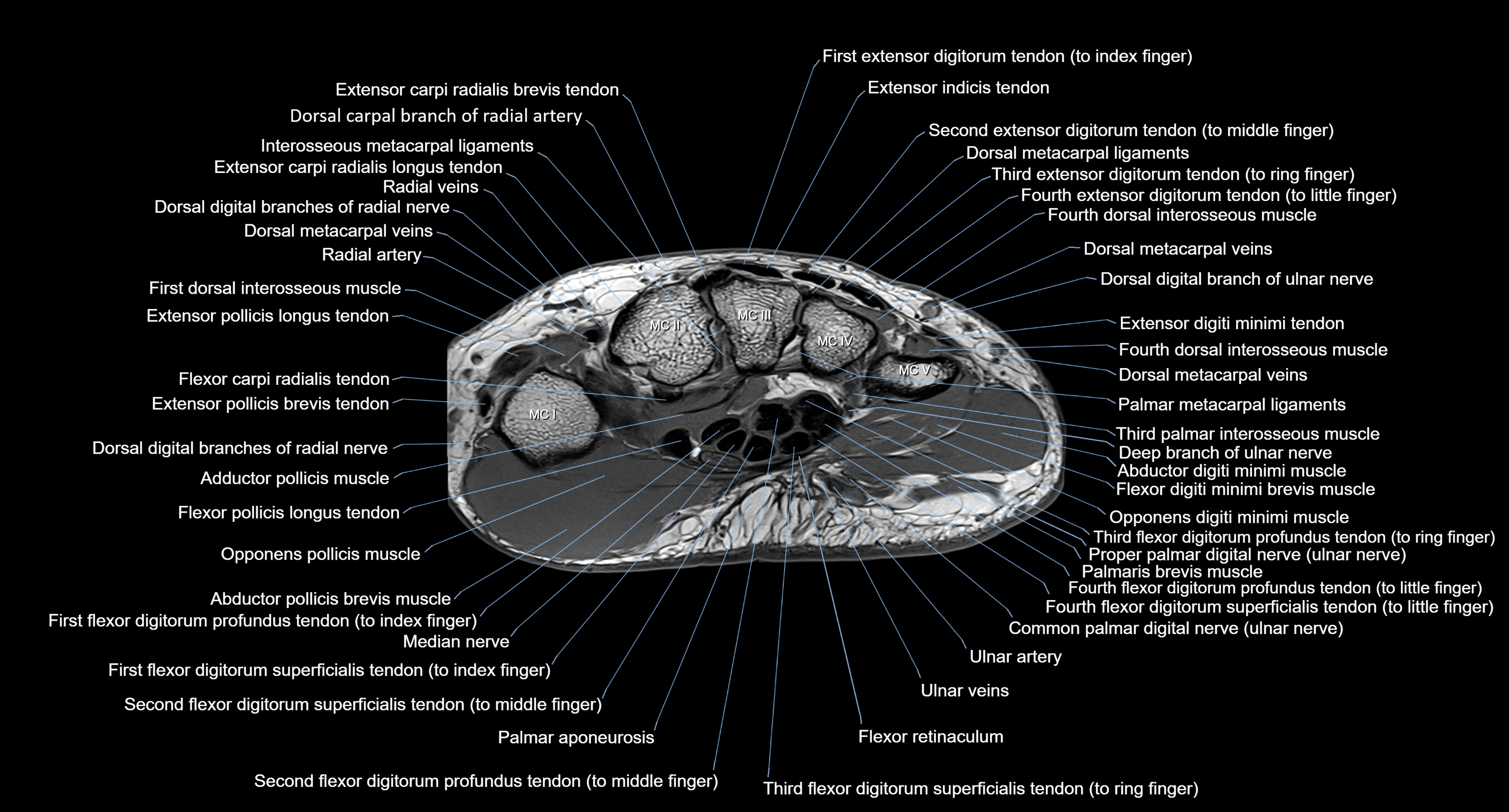 MRI Wrist Anatomy – Labeled Axial, Coronal & Sagittal Images