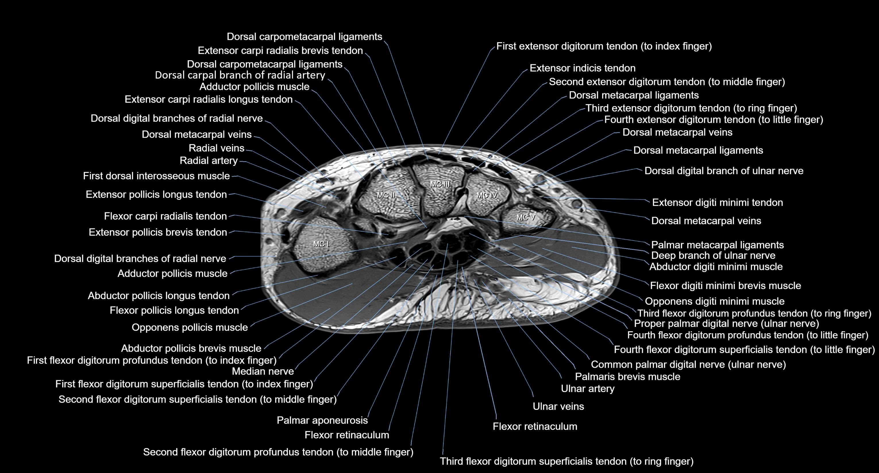 MRI Wrist Anatomy – Labeled Axial, Coronal & Sagittal Images