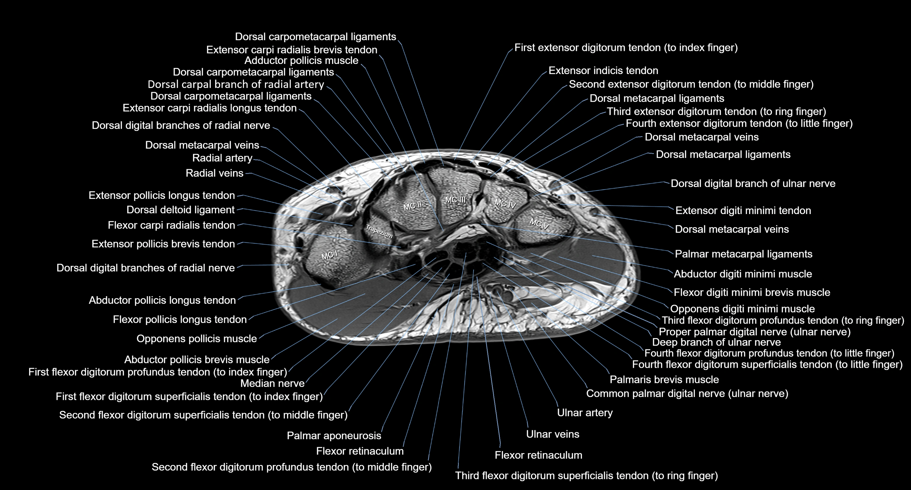 MRI Wrist Anatomy – Labeled Axial, Coronal & Sagittal Images