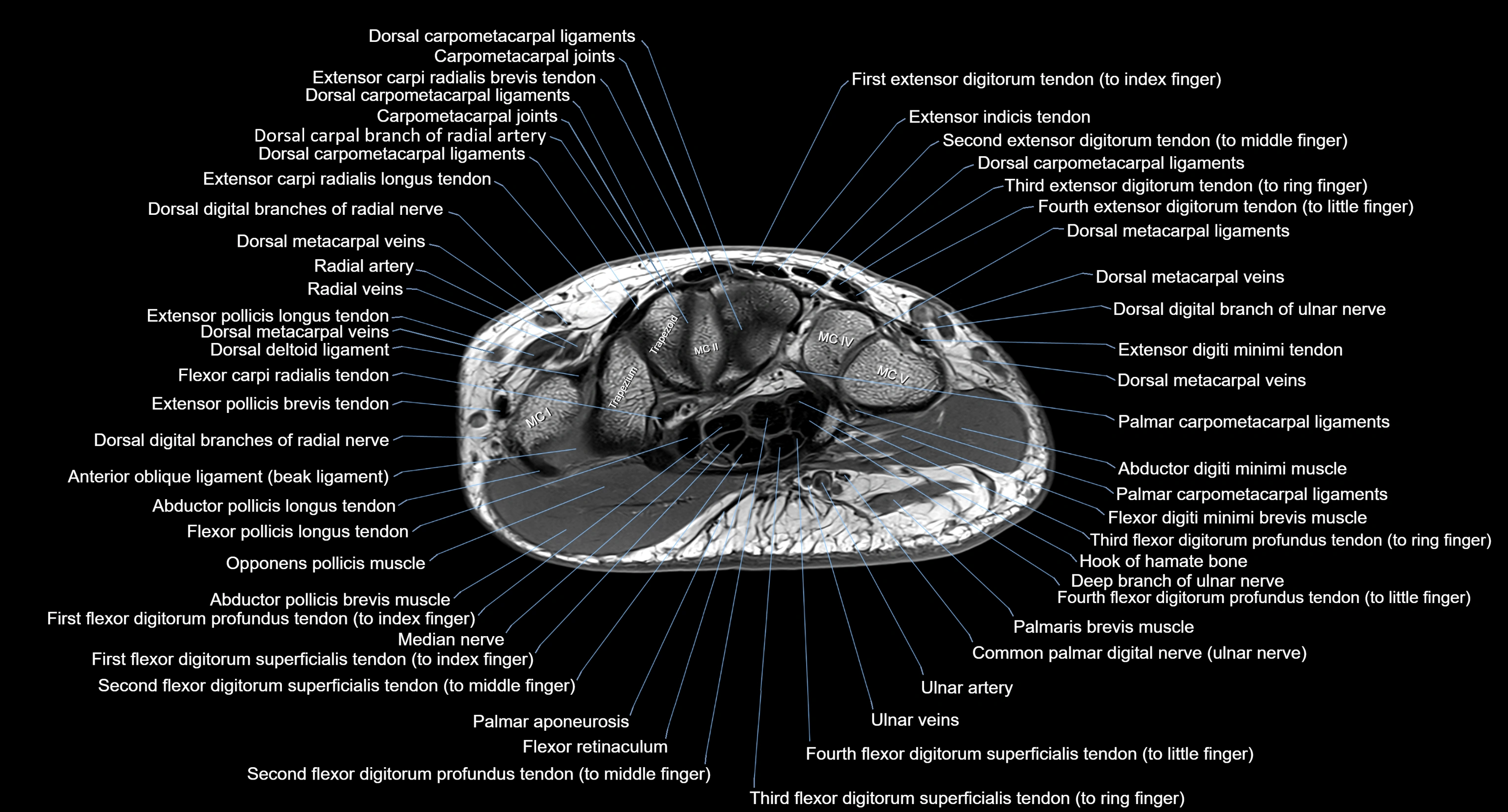 MRI Wrist Anatomy – Labeled Axial, Coronal & Sagittal Images