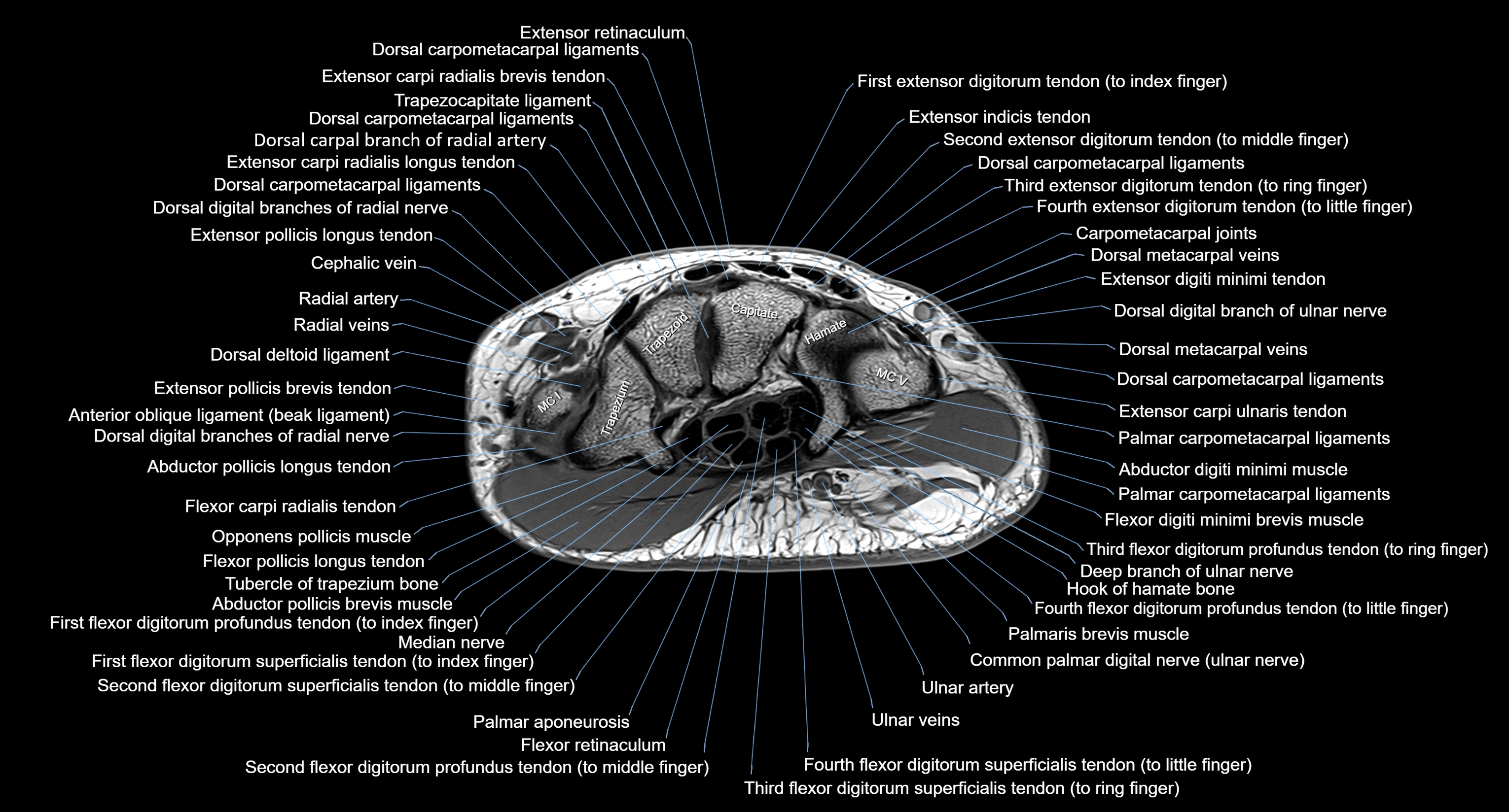 MRI Wrist Anatomy – Labeled Axial, Coronal & Sagittal Images