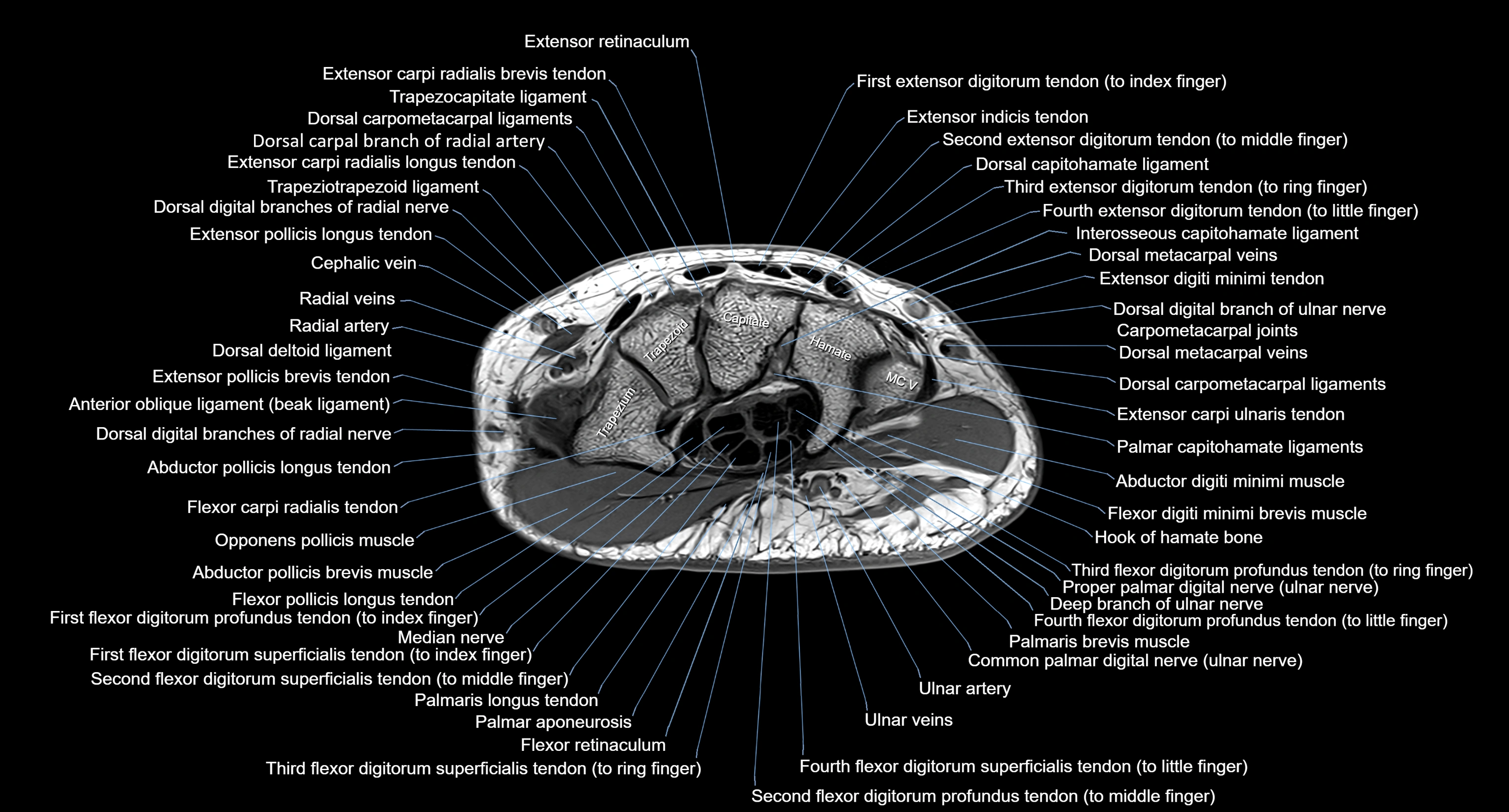 MRI Wrist Anatomy – Labeled Axial, Coronal & Sagittal Images