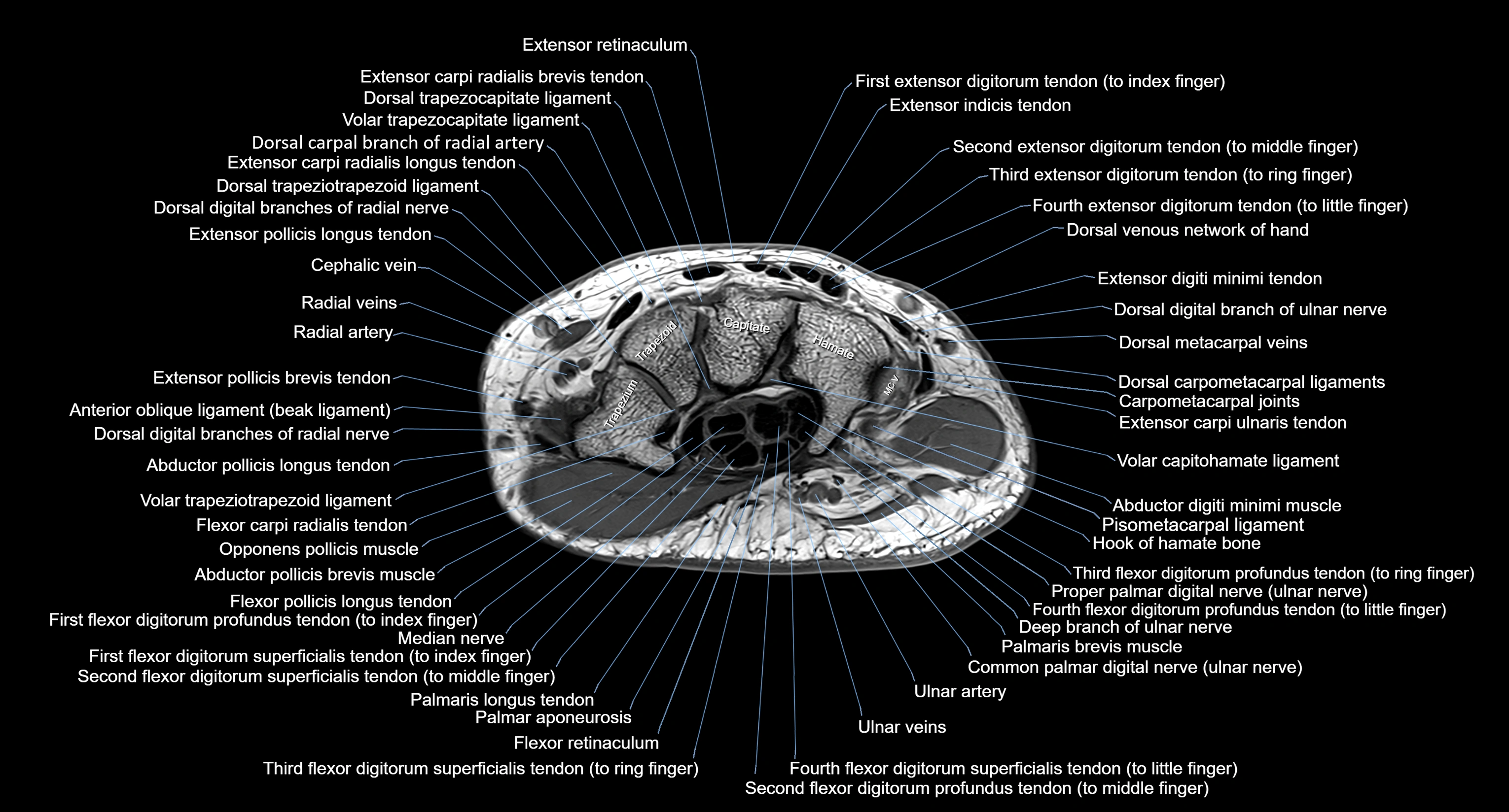 MRI Wrist Anatomy – Labeled Axial, Coronal & Sagittal Images