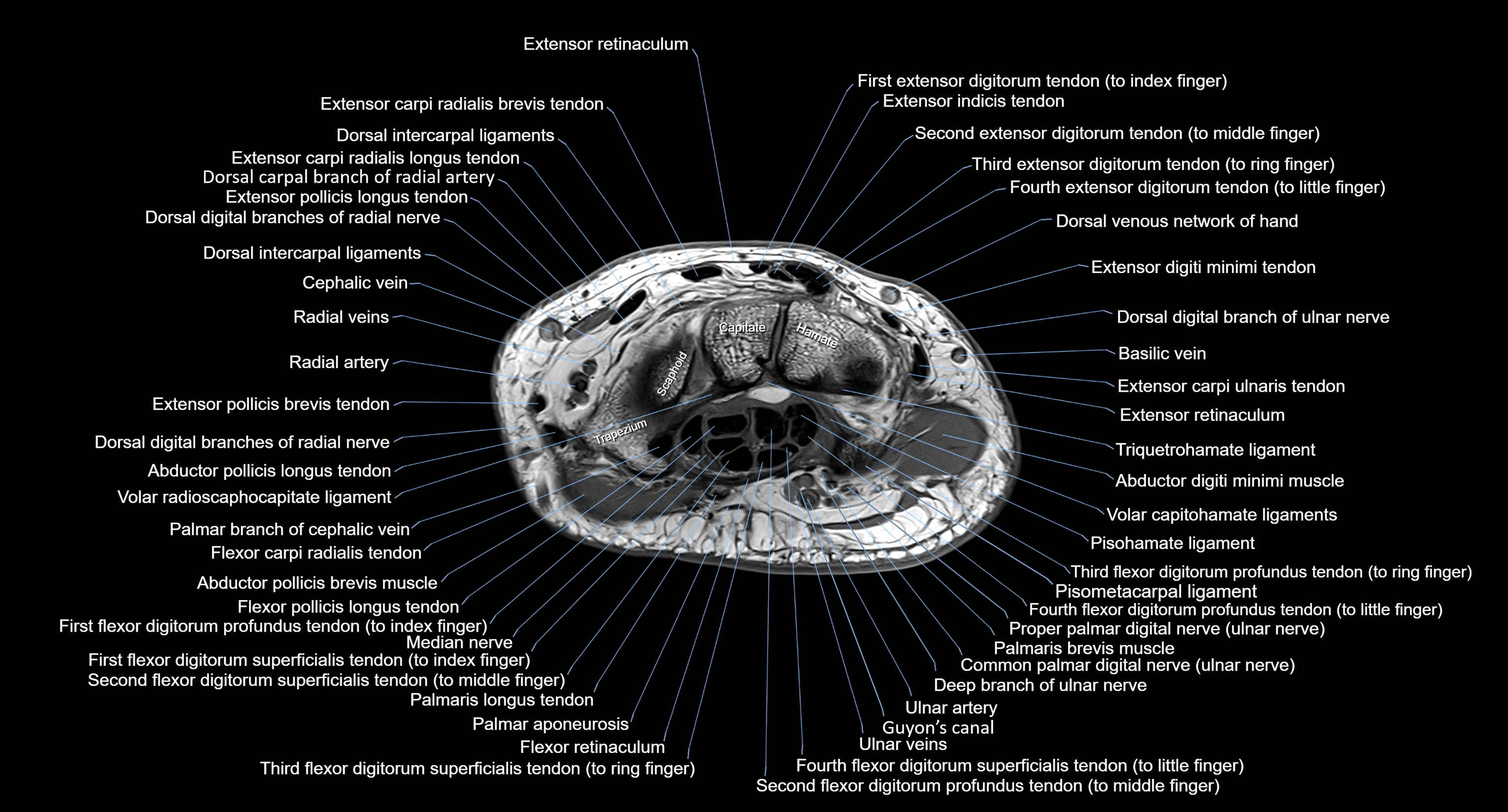 MRI Wrist Anatomy – Labeled Axial, Coronal & Sagittal Images