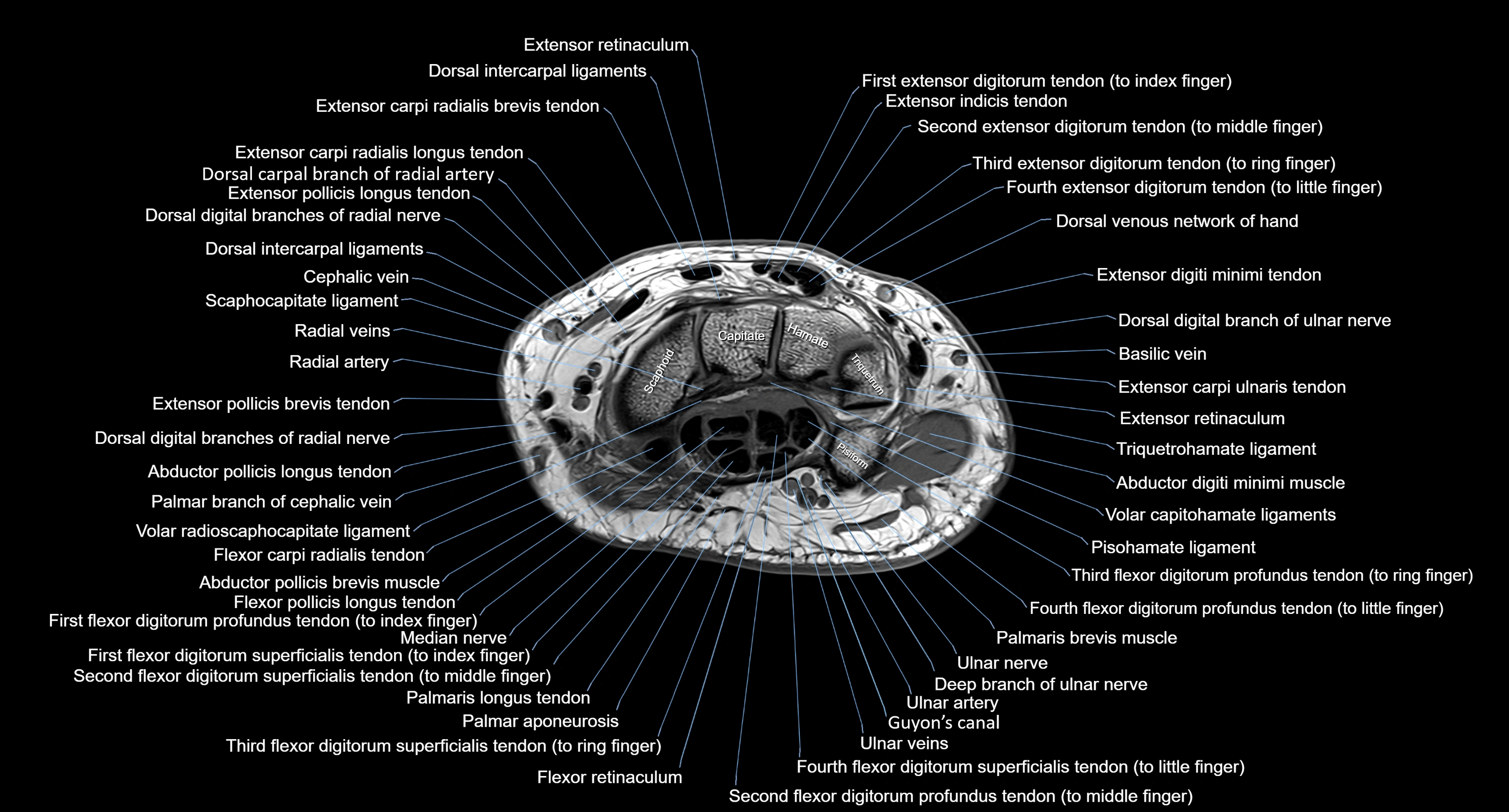 MRI Wrist Anatomy – Labeled Axial, Coronal & Sagittal Images