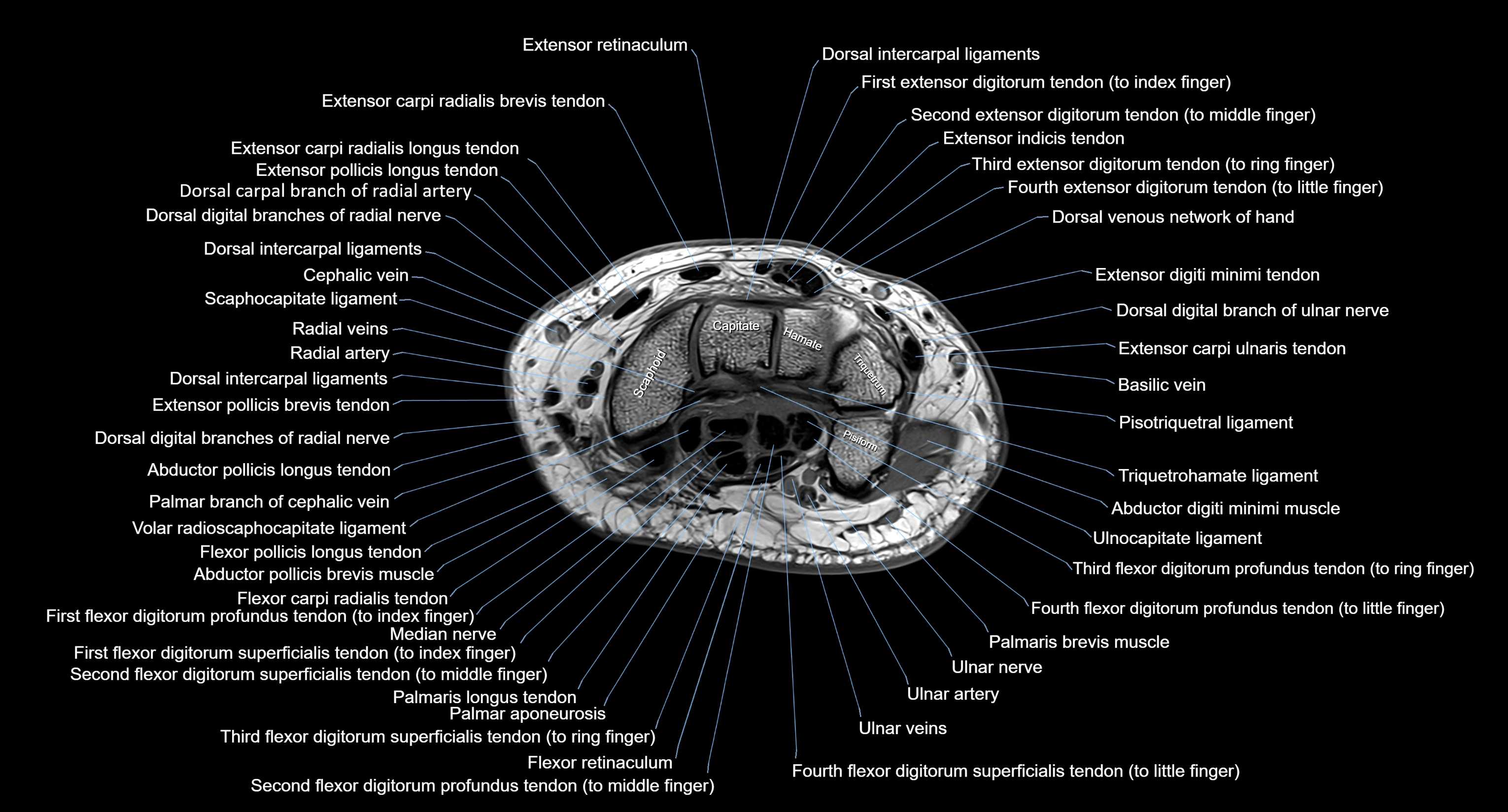 MRI Wrist Anatomy – Labeled Axial, Coronal & Sagittal Images