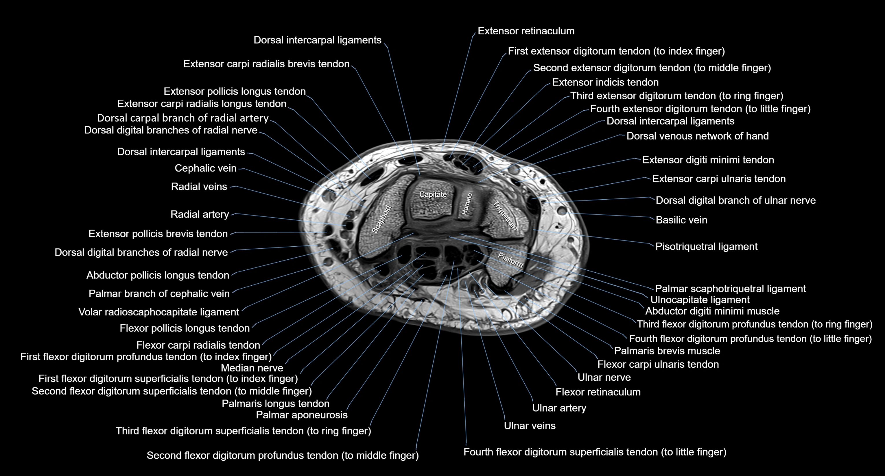 MRI Wrist Anatomy – Labeled Axial, Coronal & Sagittal Images