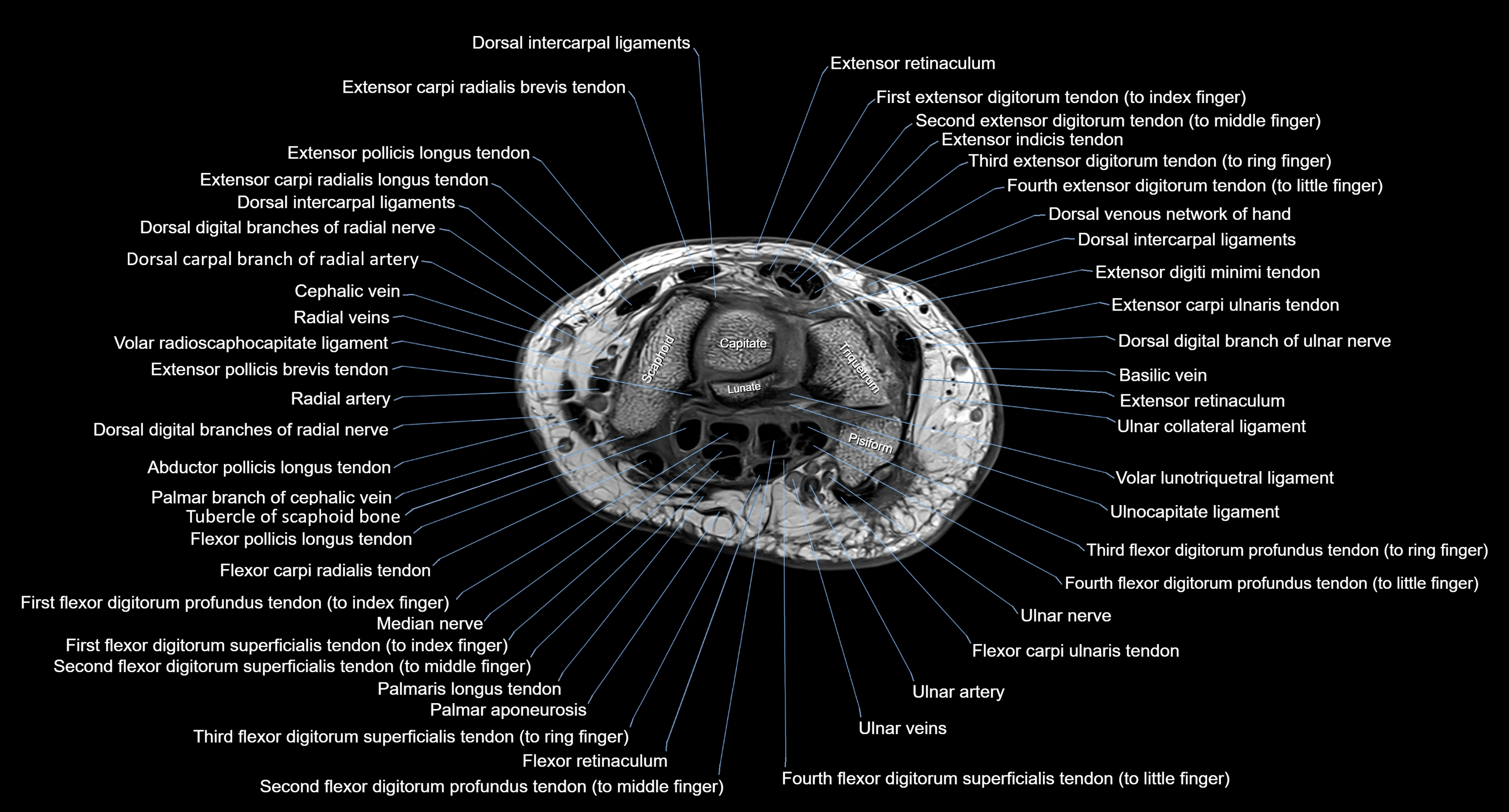 MRI Wrist Anatomy – Labeled Axial, Coronal & Sagittal Images