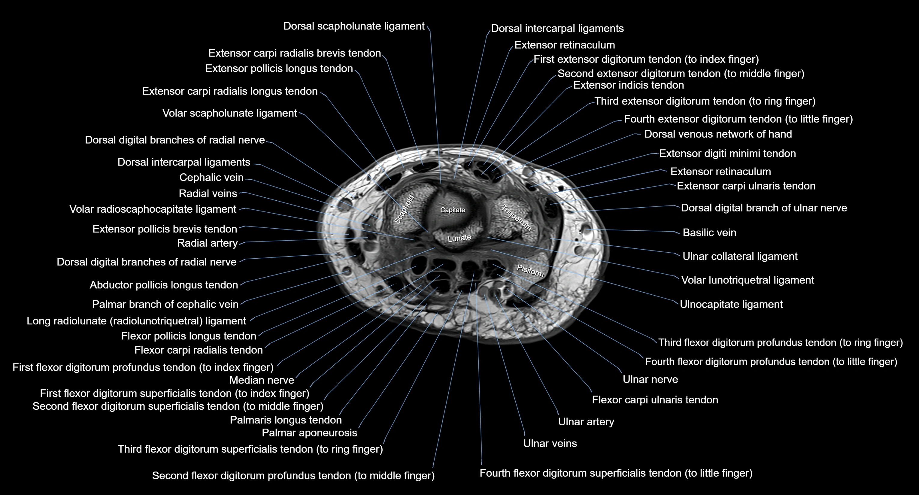 MRI Wrist Anatomy – Labeled Axial, Coronal & Sagittal Images