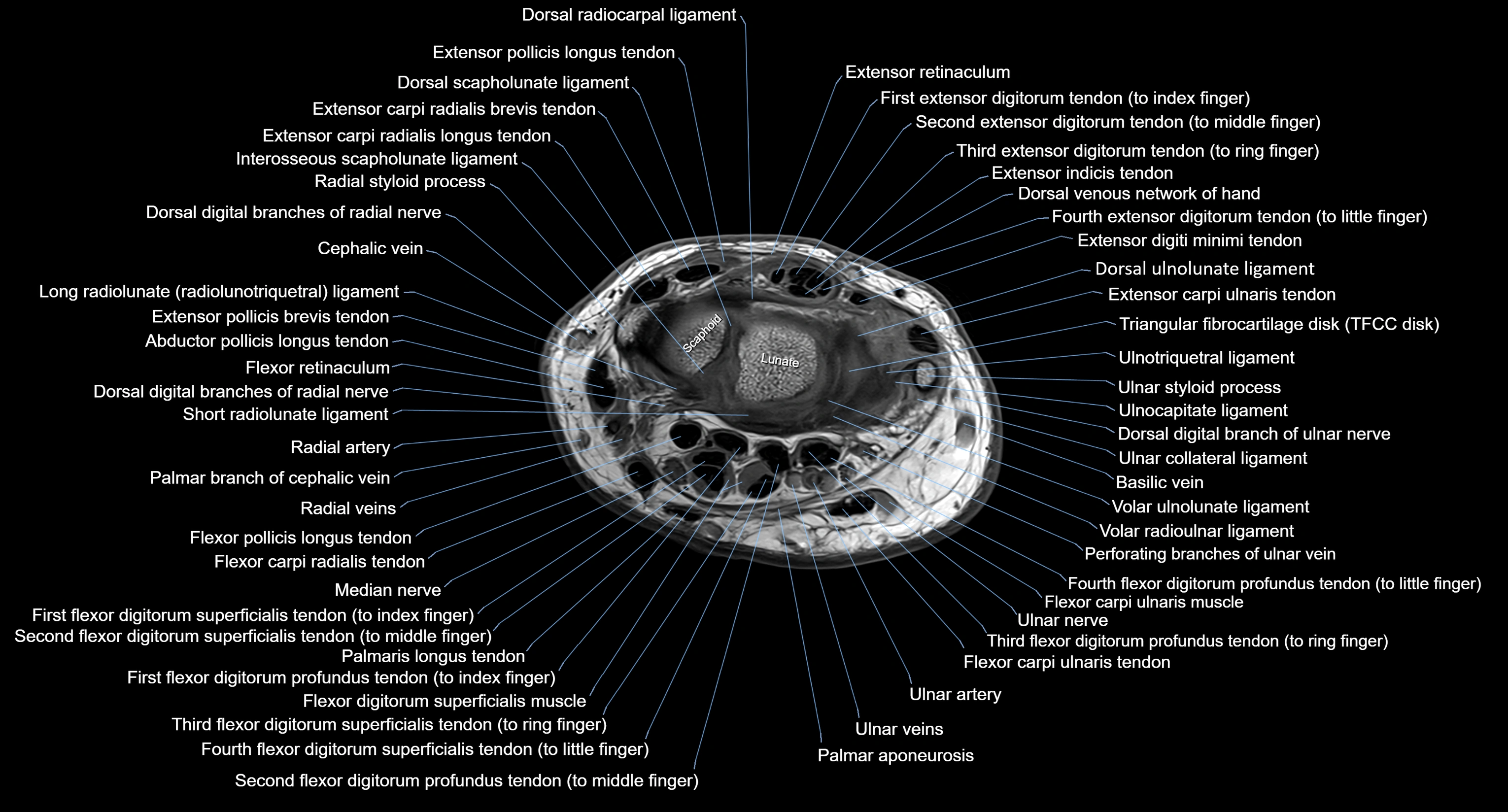 MRI Wrist Anatomy – Labeled Axial, Coronal & Sagittal Images