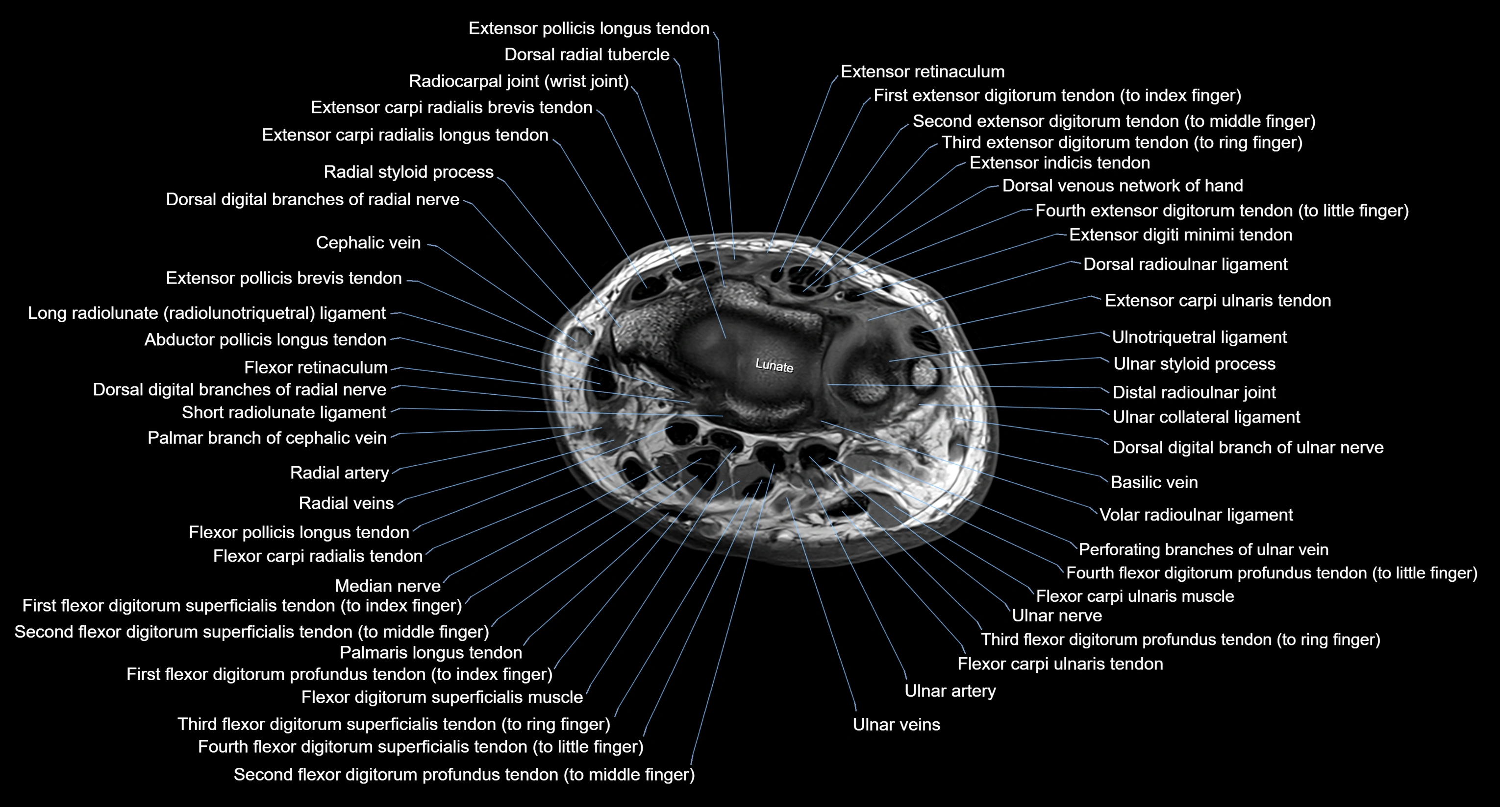 MRI Wrist Anatomy – Labeled Axial, Coronal & Sagittal Images