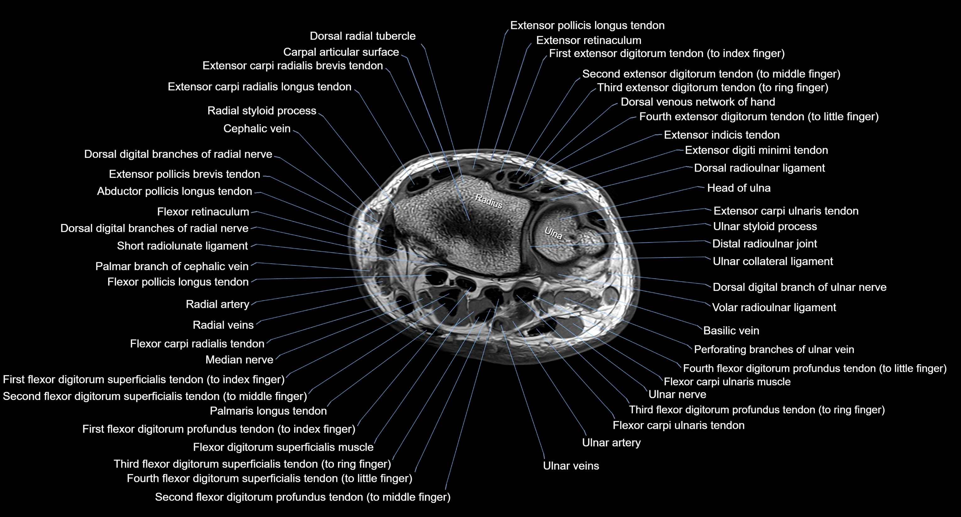 MRI Wrist Anatomy – Labeled Axial, Coronal & Sagittal Images