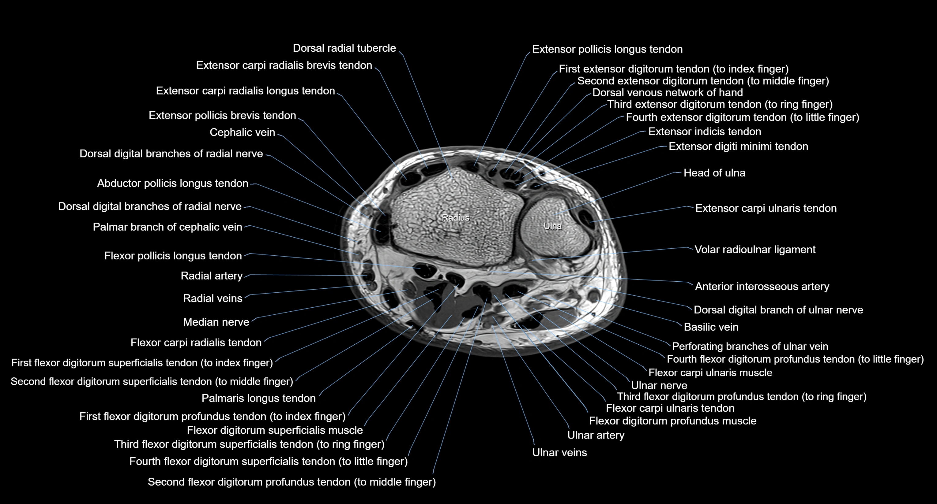 MRI Wrist Anatomy – Labeled Axial, Coronal & Sagittal Images