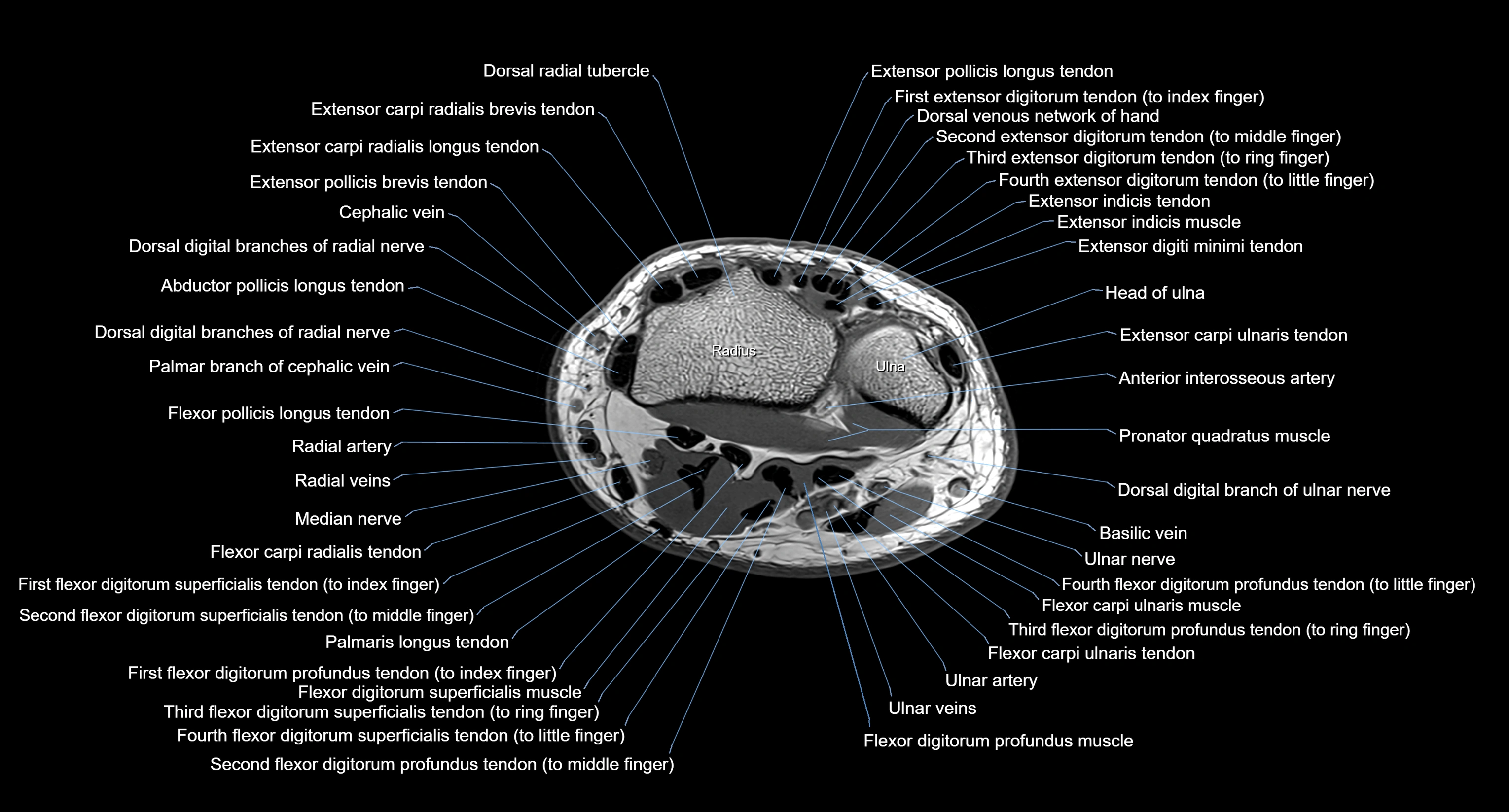 MRI Wrist Anatomy – Labeled Axial, Coronal & Sagittal Images
