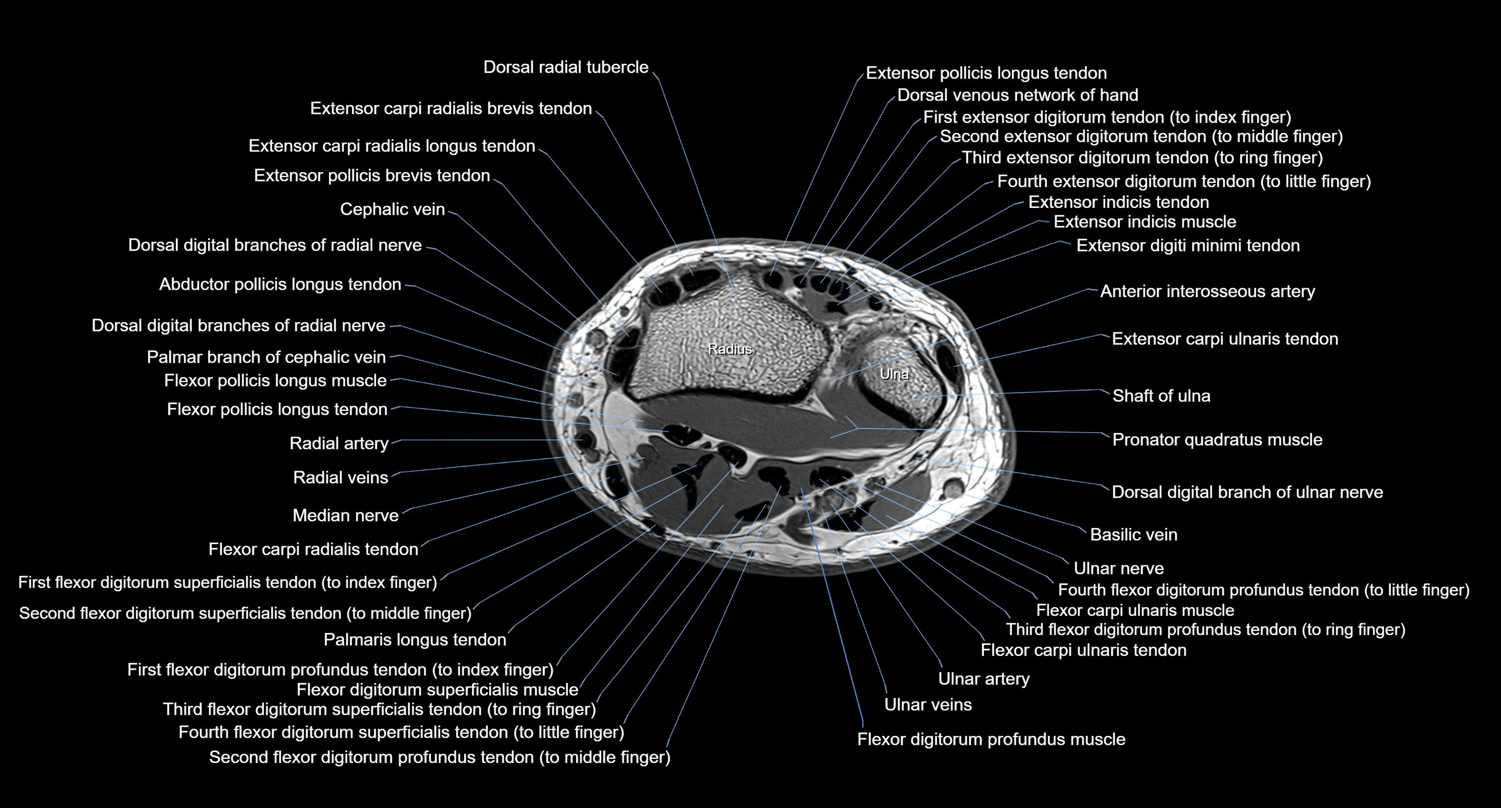 MRI Wrist Anatomy – Labeled Axial, Coronal & Sagittal Images
