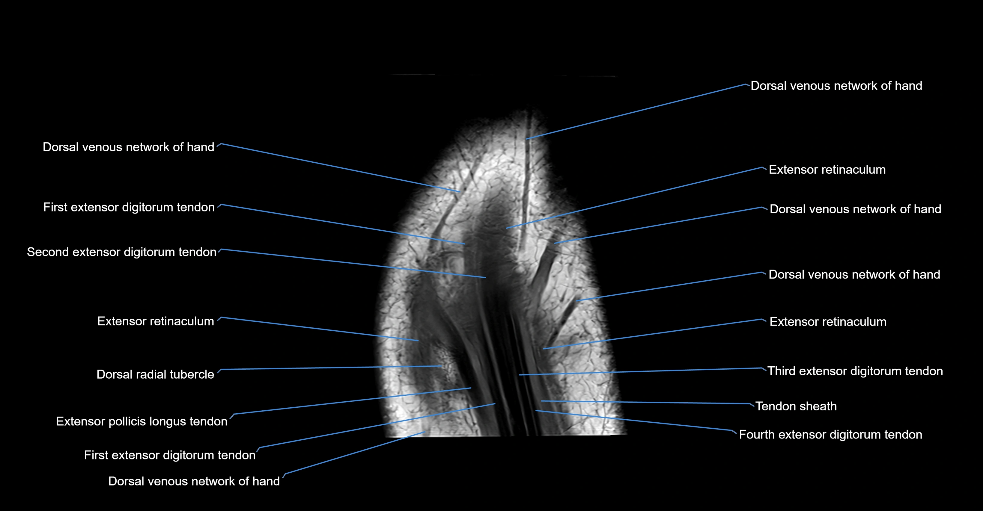 MRI Wrist Anatomy – Labeled Axial, Coronal & Sagittal Images