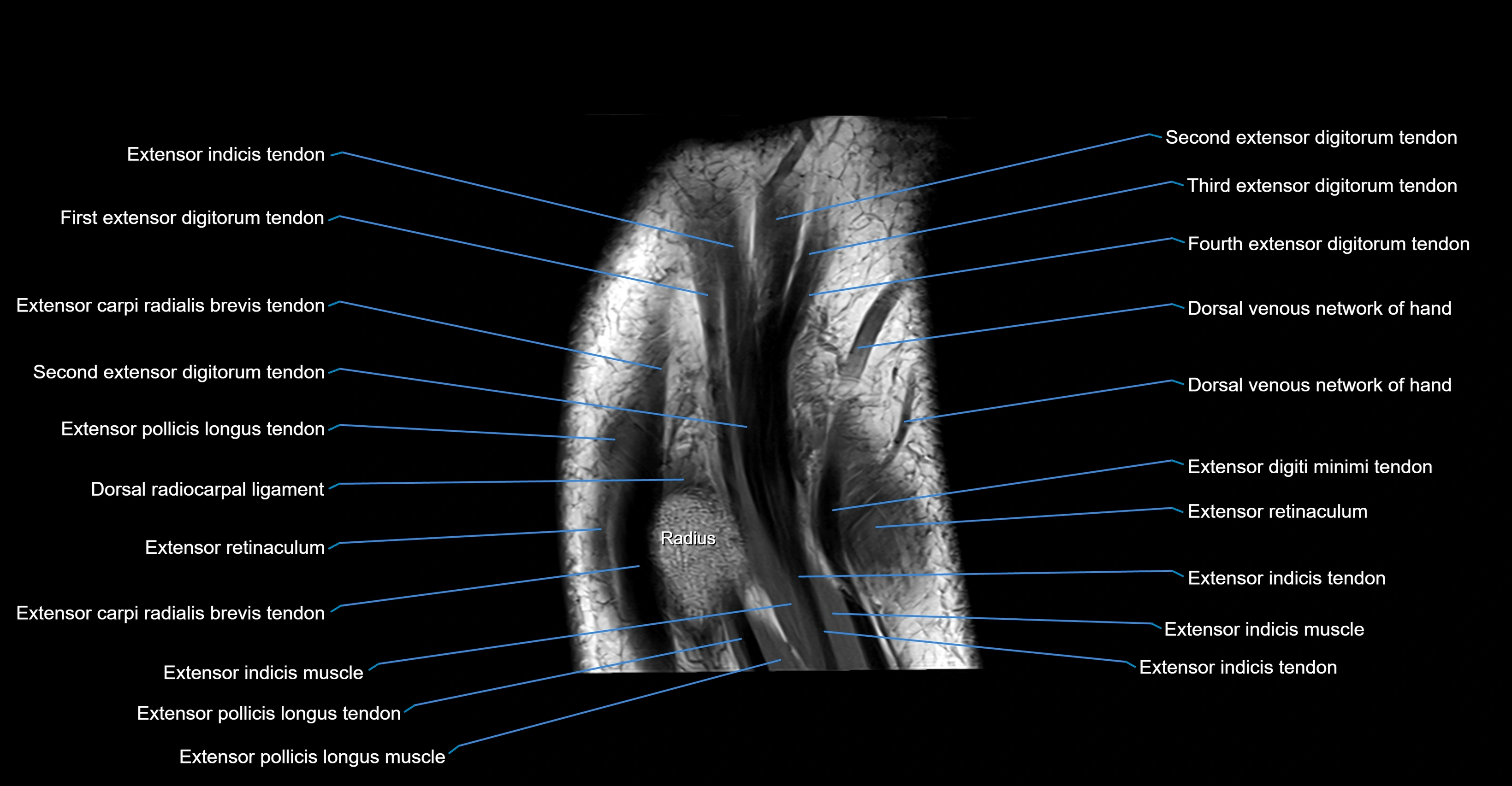 MRI Wrist Anatomy – Labeled Axial, Coronal & Sagittal Images
