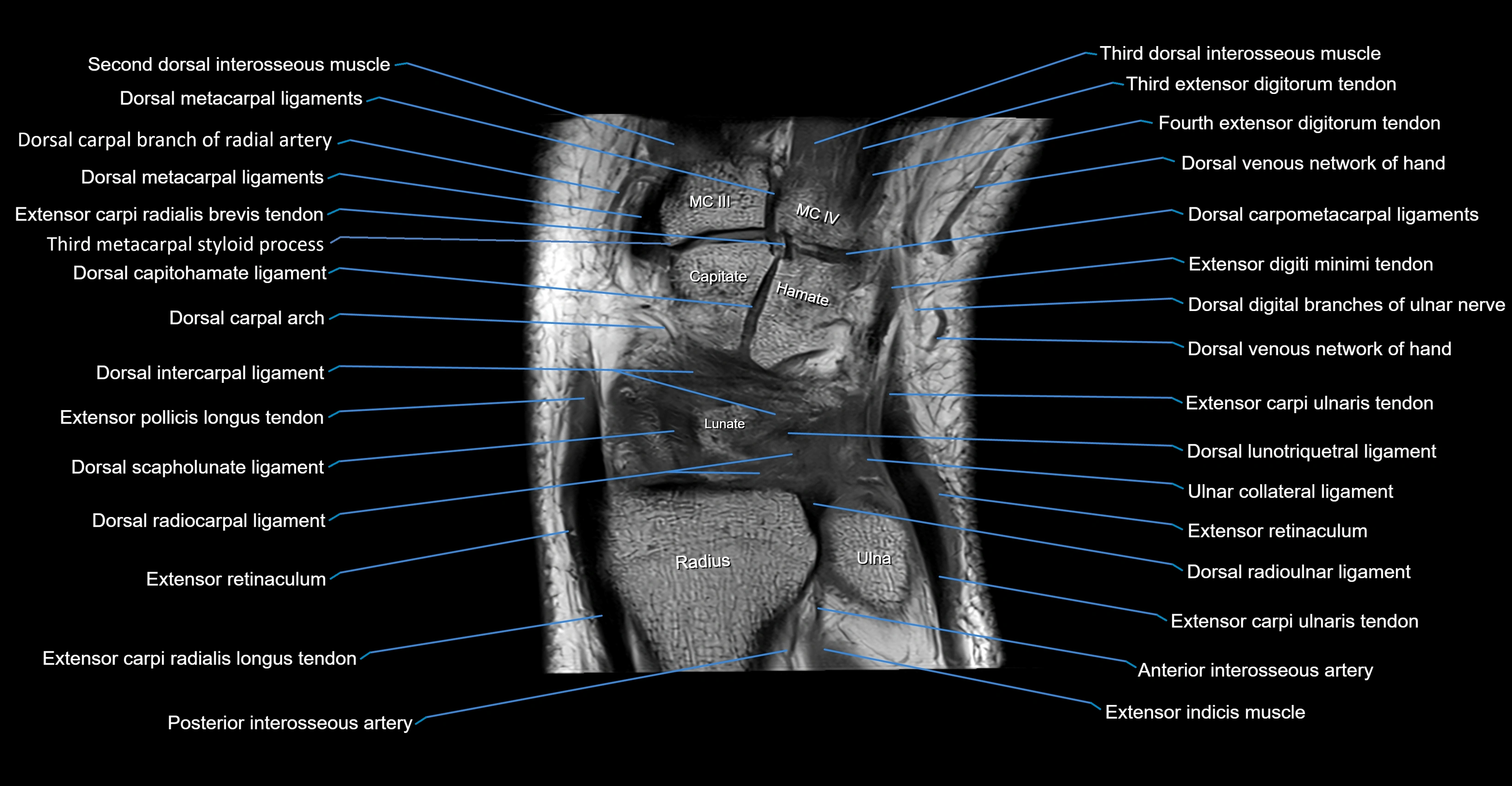 MRI Wrist Anatomy – Labeled Axial, Coronal & Sagittal Images