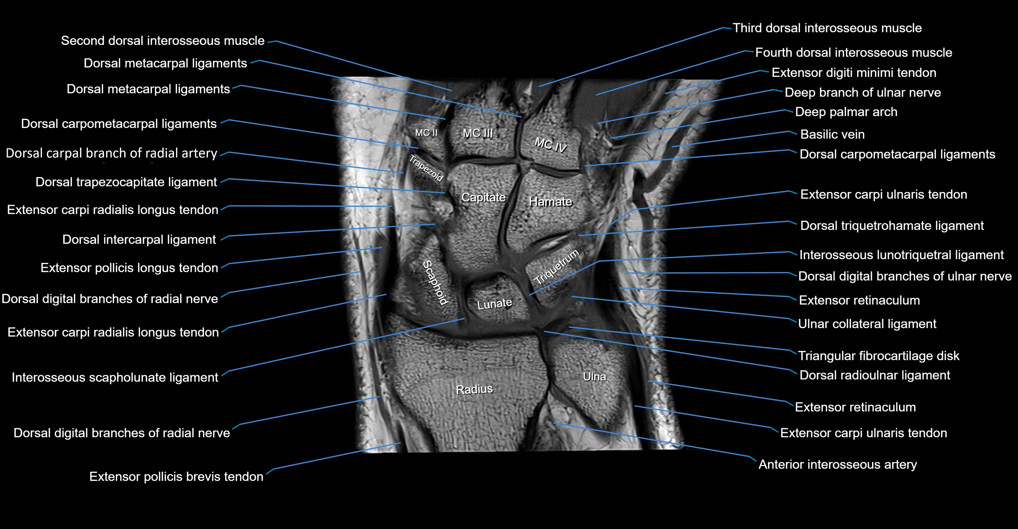 MRI Wrist Anatomy – Labeled Axial, Coronal & Sagittal Images