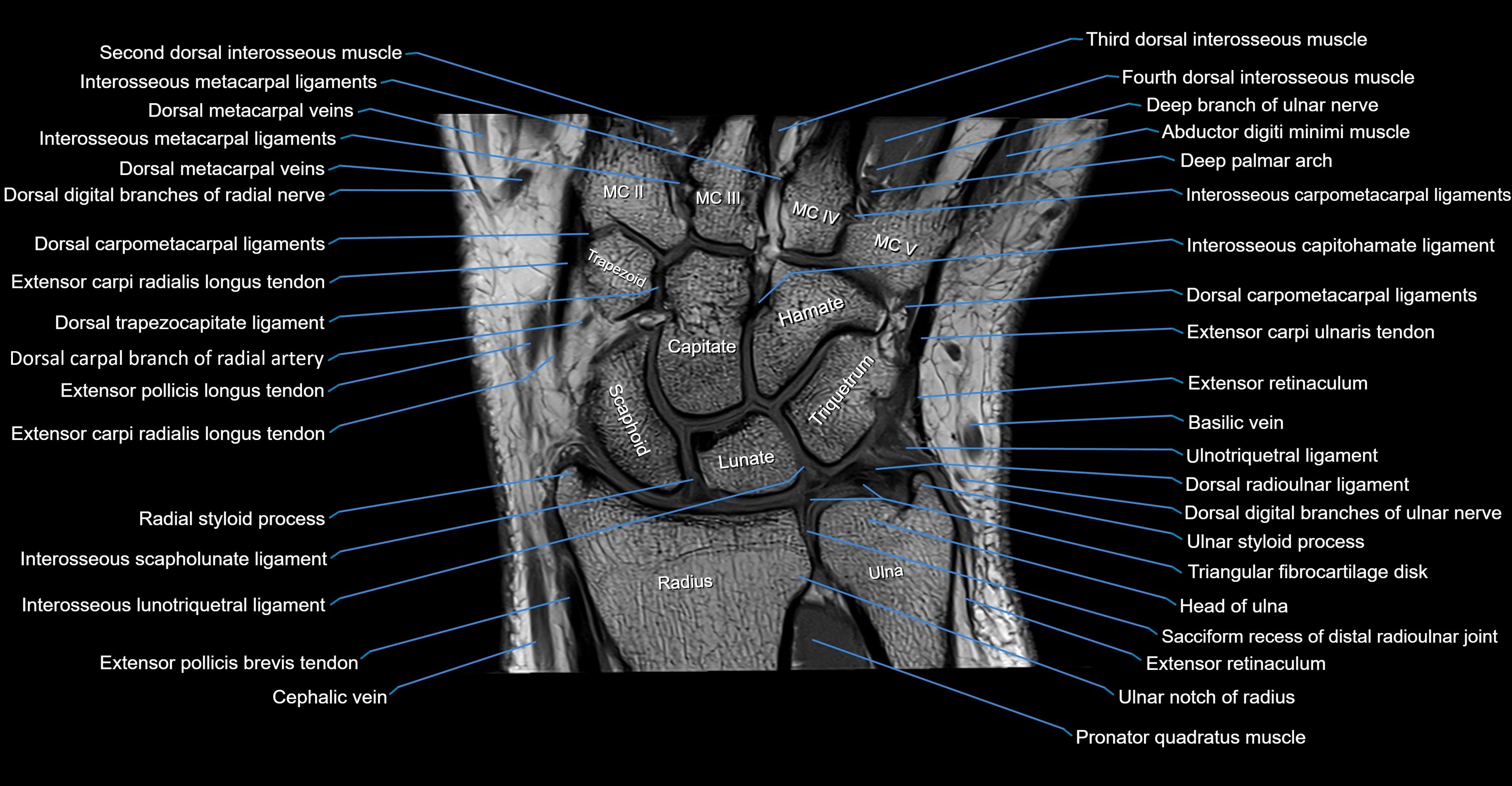 MRI Wrist Anatomy – Labeled Axial, Coronal & Sagittal Images