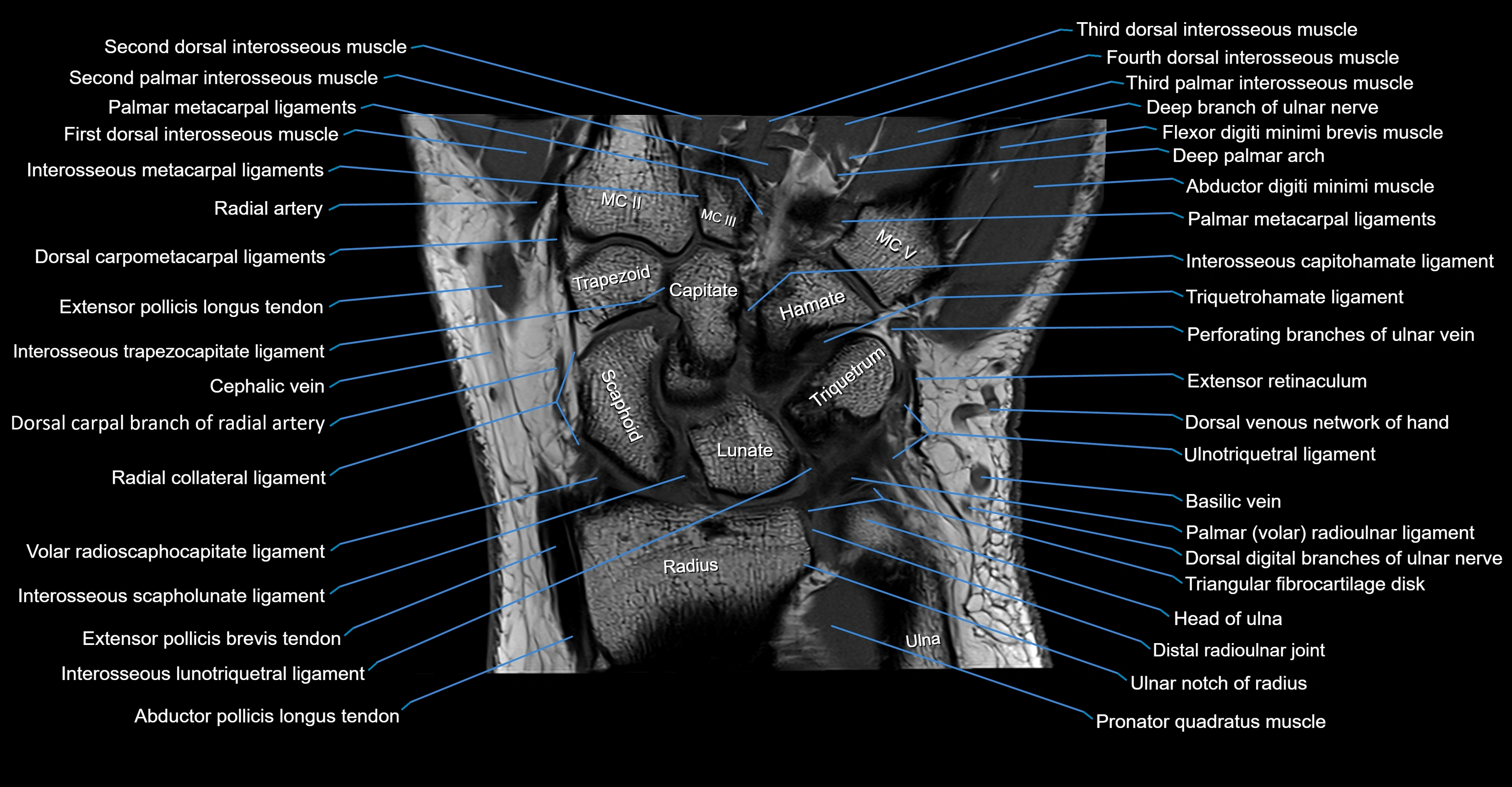 MRI Wrist Anatomy – Labeled Axial, Coronal & Sagittal Images