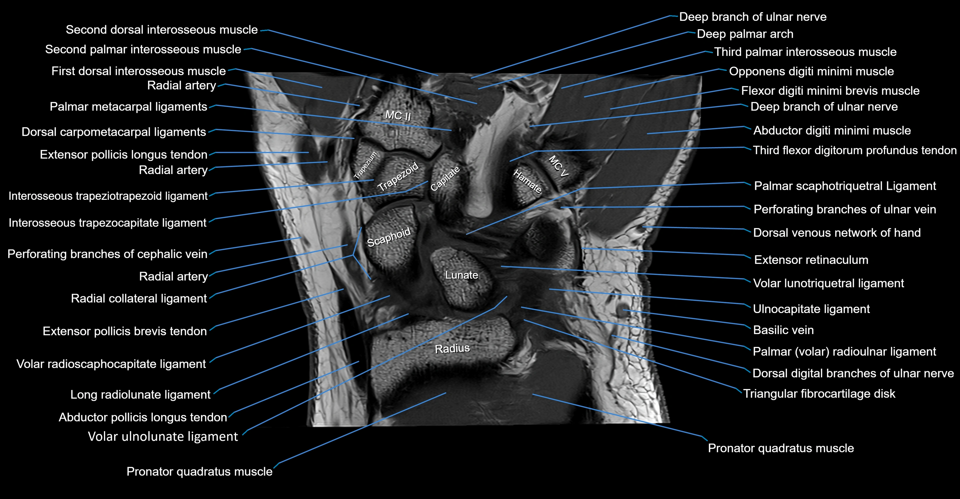 MRI Wrist Anatomy – Labeled Axial, Coronal & Sagittal Images