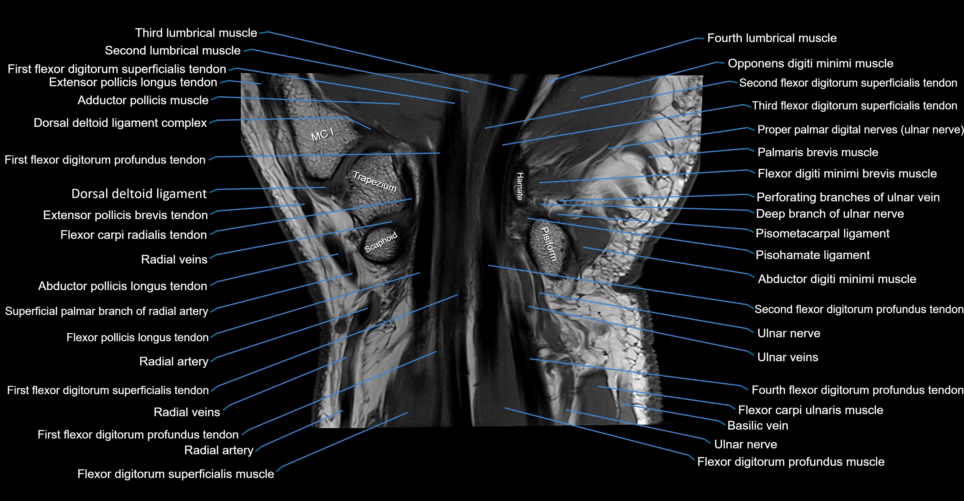 MRI Wrist Anatomy – Labeled Axial, Coronal & Sagittal Images