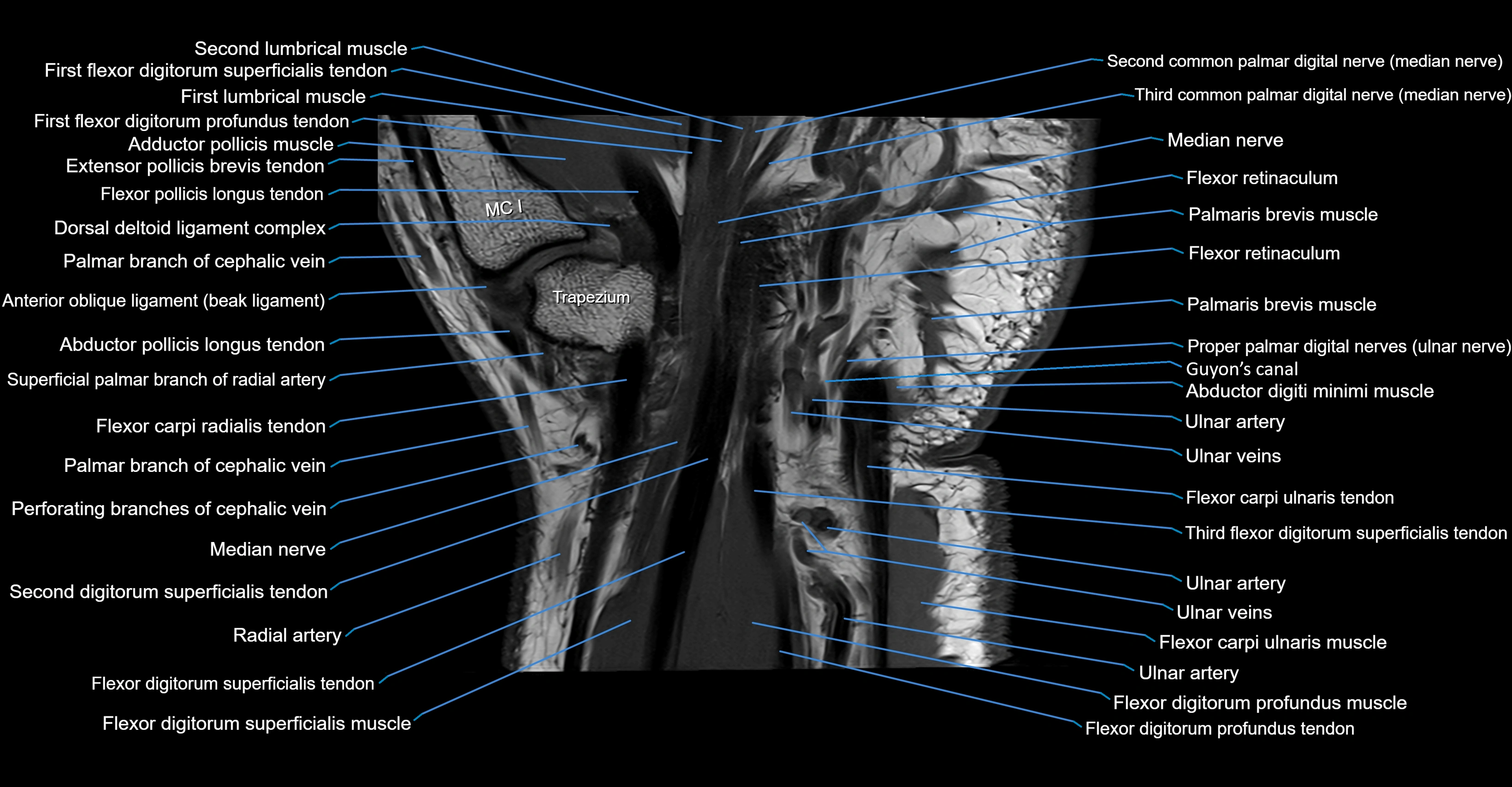 MRI Wrist Anatomy – Labeled Axial, Coronal & Sagittal Images