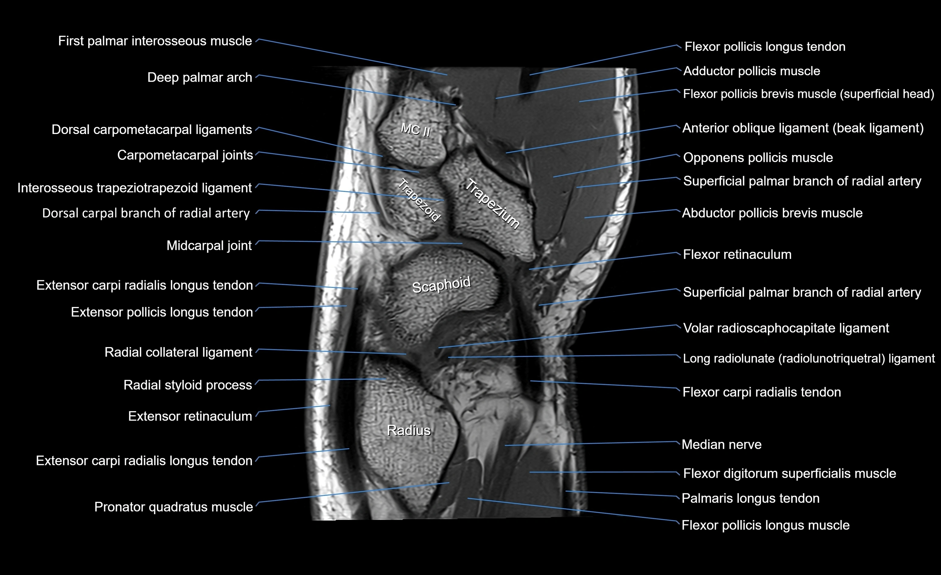 MRI Wrist Anatomy – Labeled Axial, Coronal & Sagittal Images