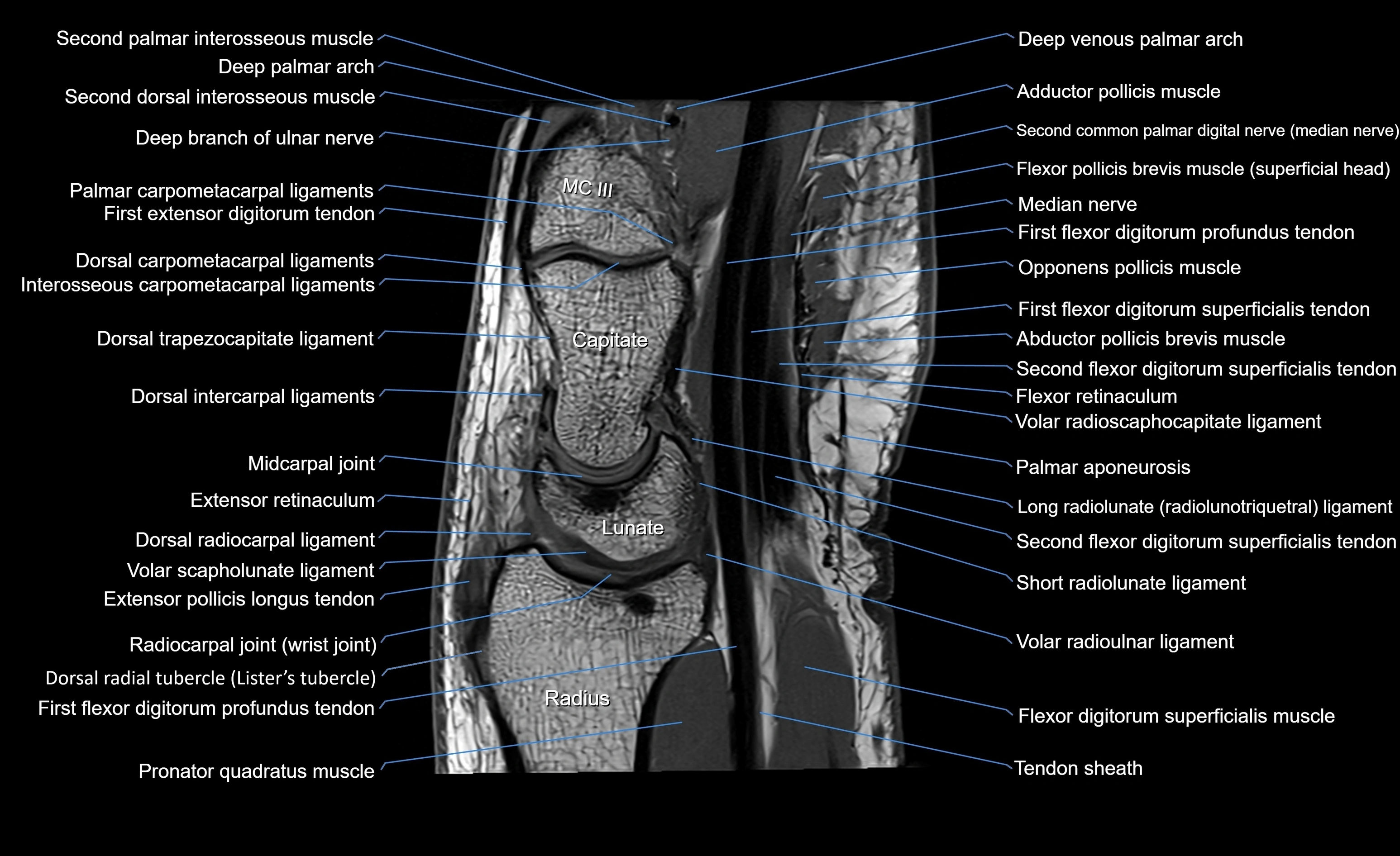 MRI Wrist Anatomy – Labeled Axial, Coronal & Sagittal Images