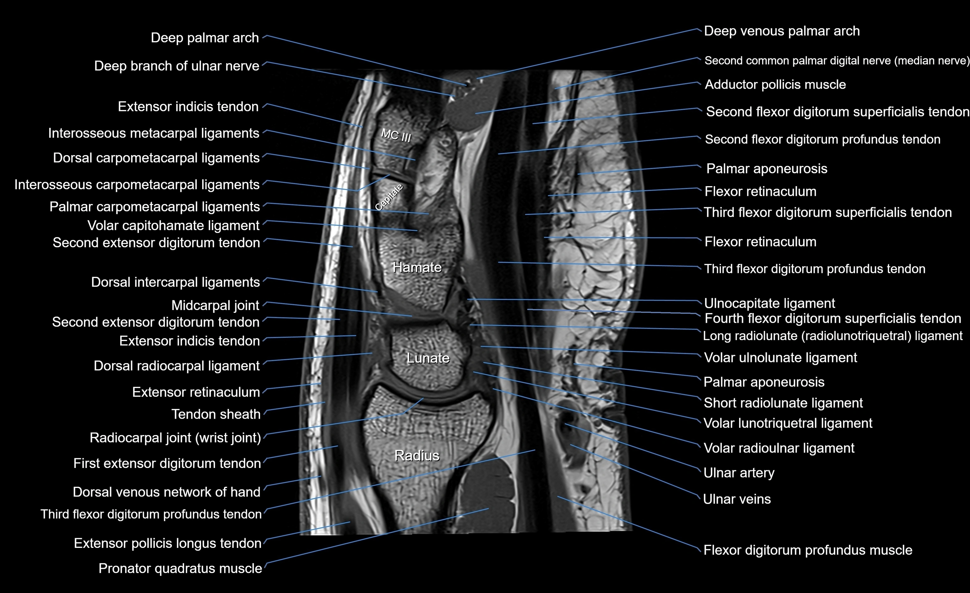 MRI Wrist Anatomy – Labeled Axial, Coronal & Sagittal Images