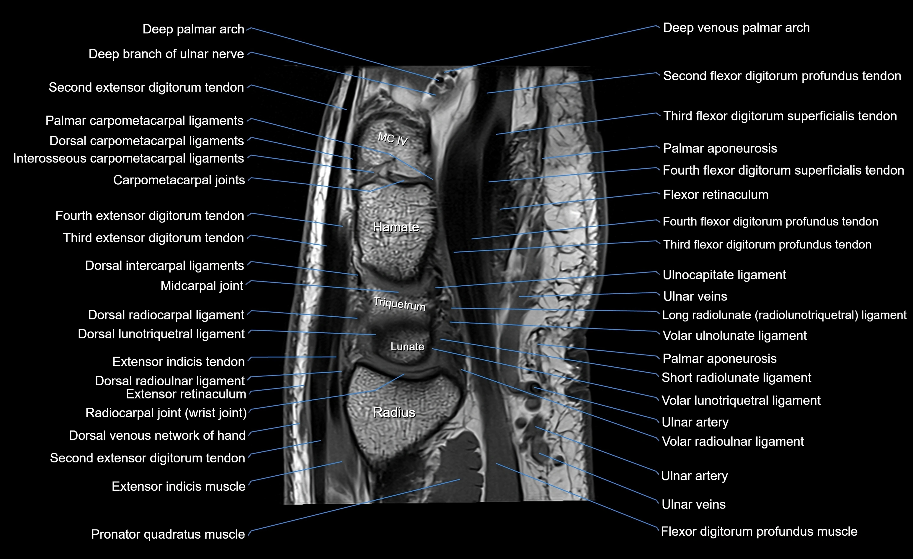 MRI Wrist Anatomy – Labeled Axial, Coronal & Sagittal Images