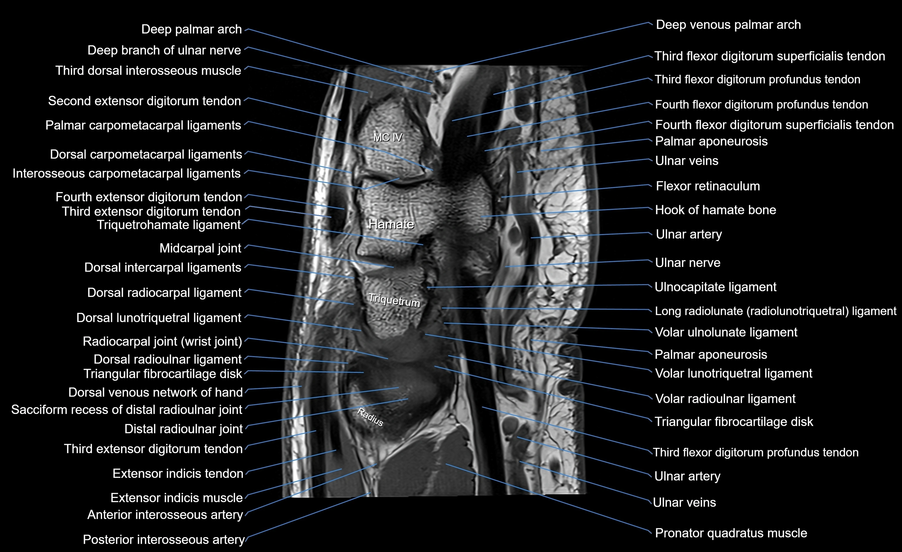 MRI Wrist Anatomy – Labeled Axial, Coronal & Sagittal Images