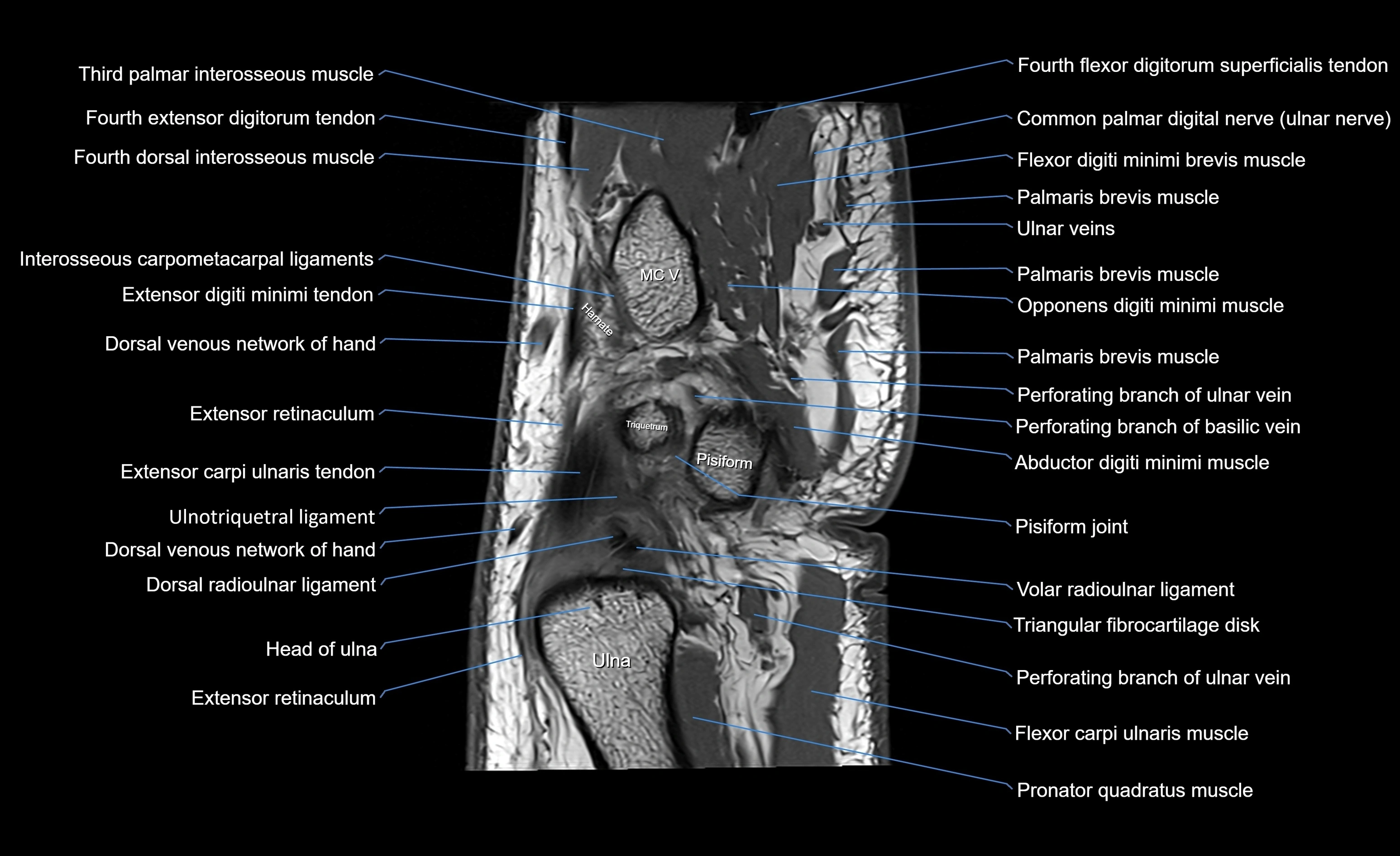 MRI Wrist Anatomy – Labeled Axial, Coronal & Sagittal Images
