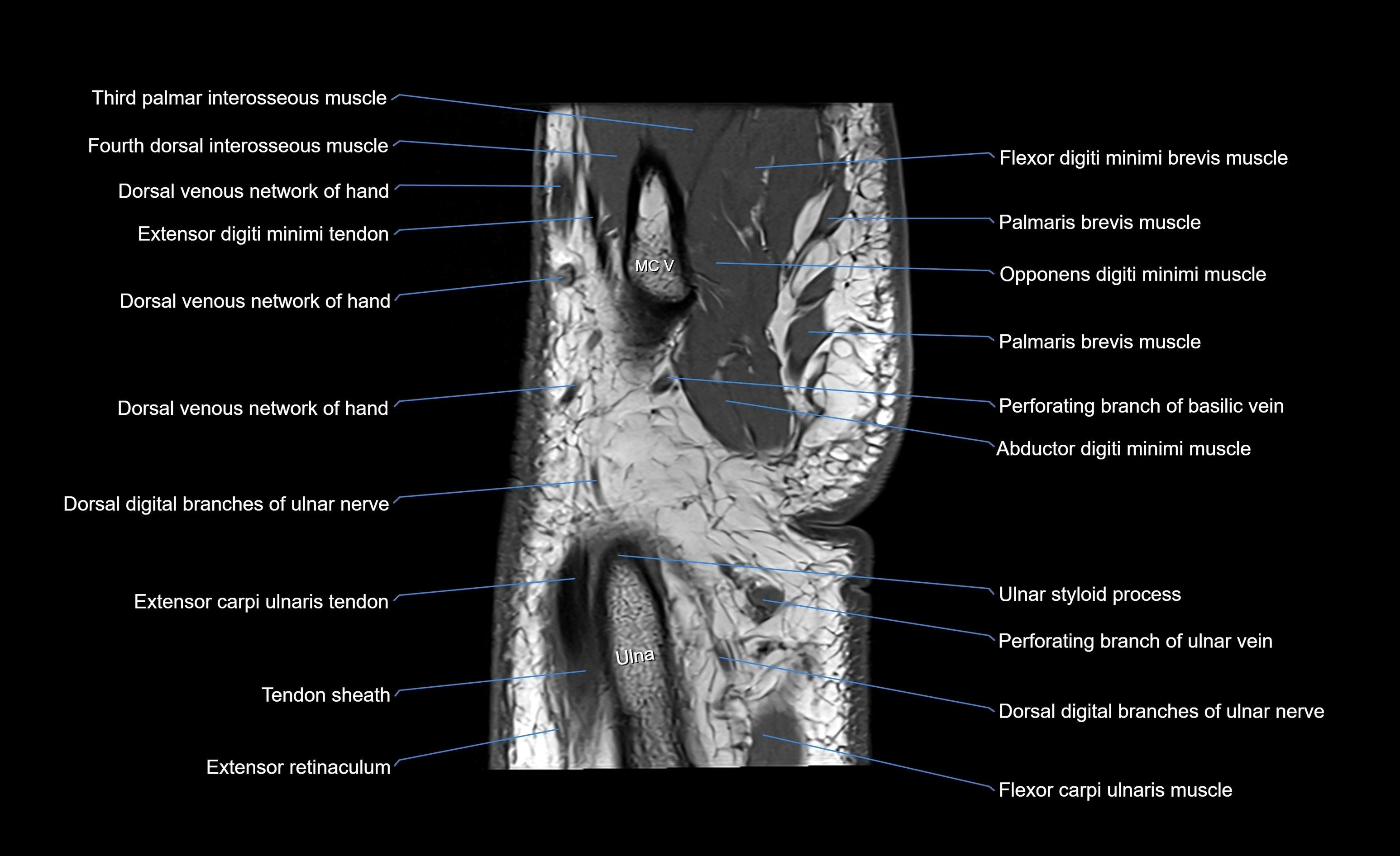 MRI Wrist Anatomy – Labeled Axial, Coronal & Sagittal Images