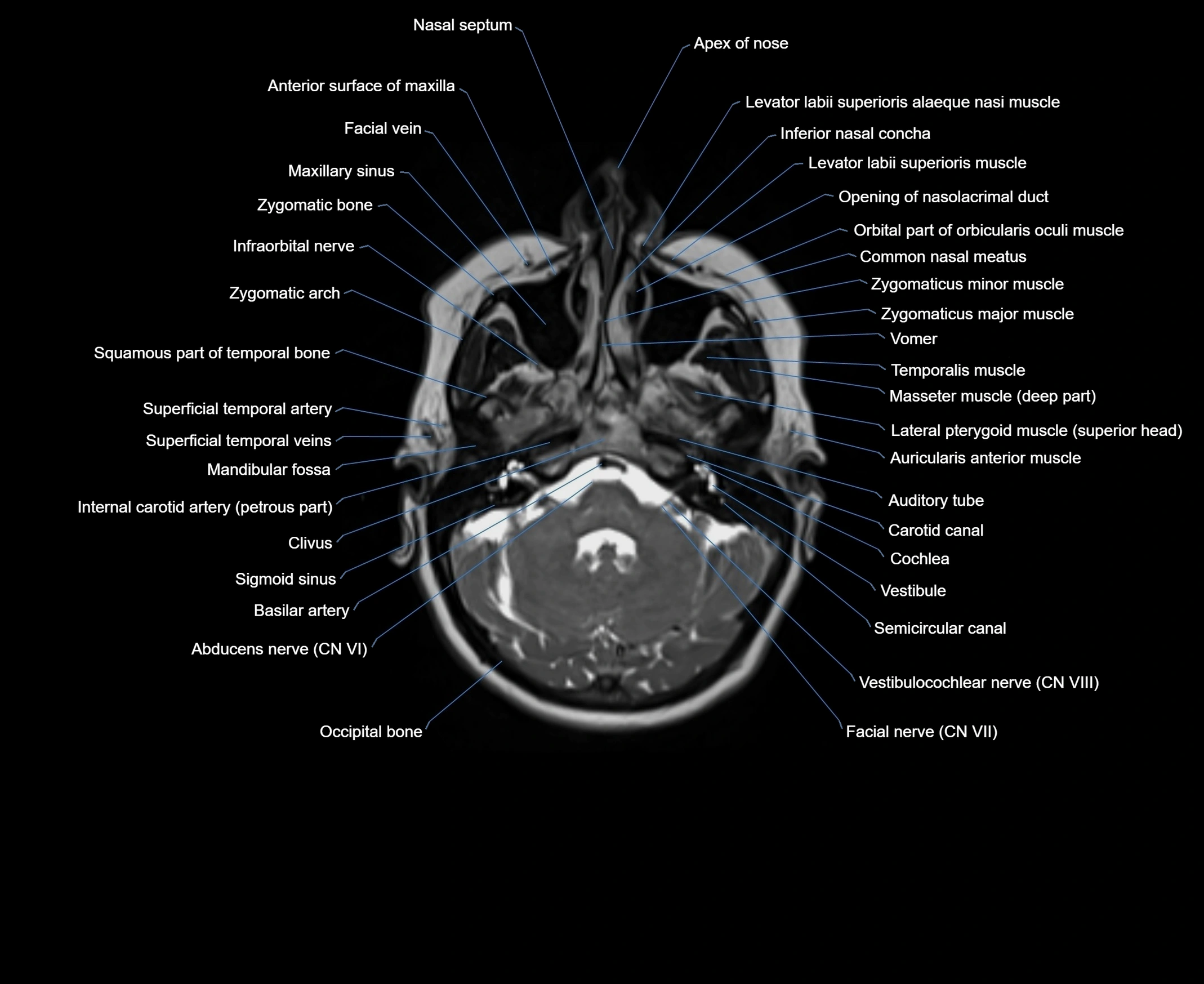 Navicular Cortex Mri MRI Orbits Anatomy – Labeled Axial, Coronal & Sagittal Sections