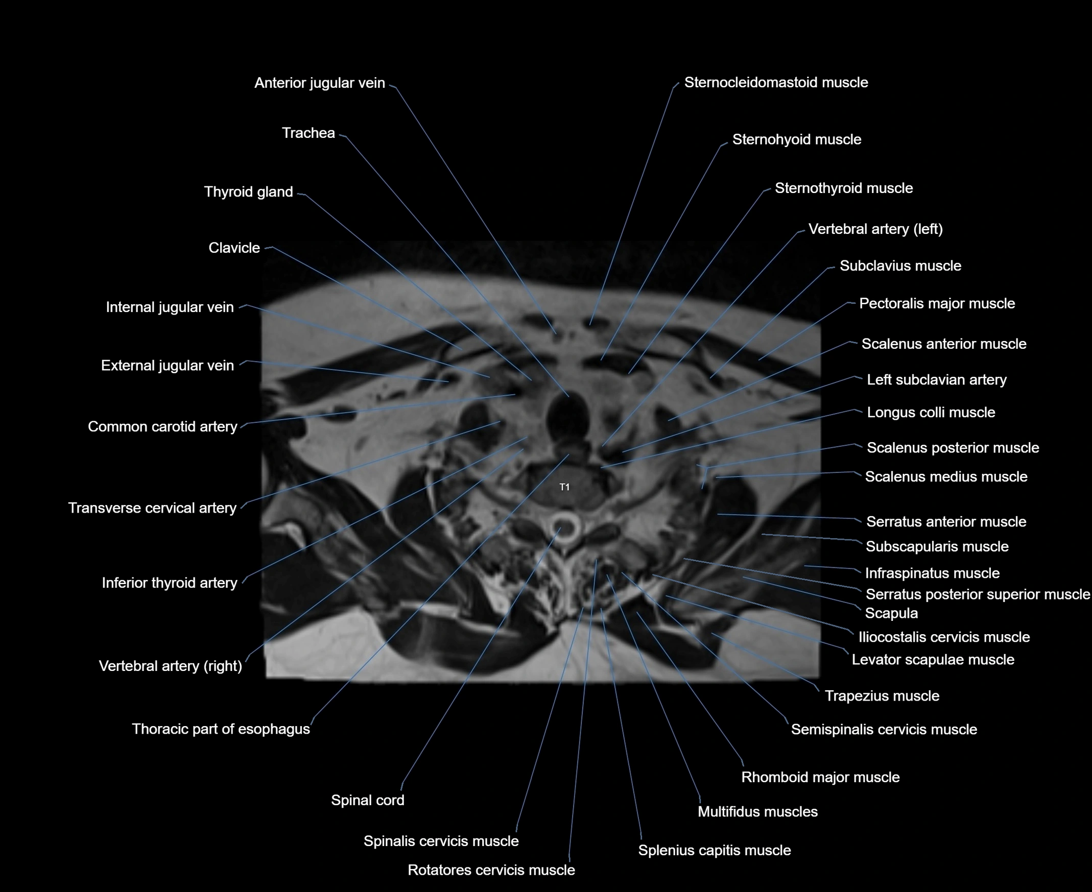 Navicular Cortex Mri MRI Orbits Anatomy – Labeled Axial, Coronal & Sagittal Sections