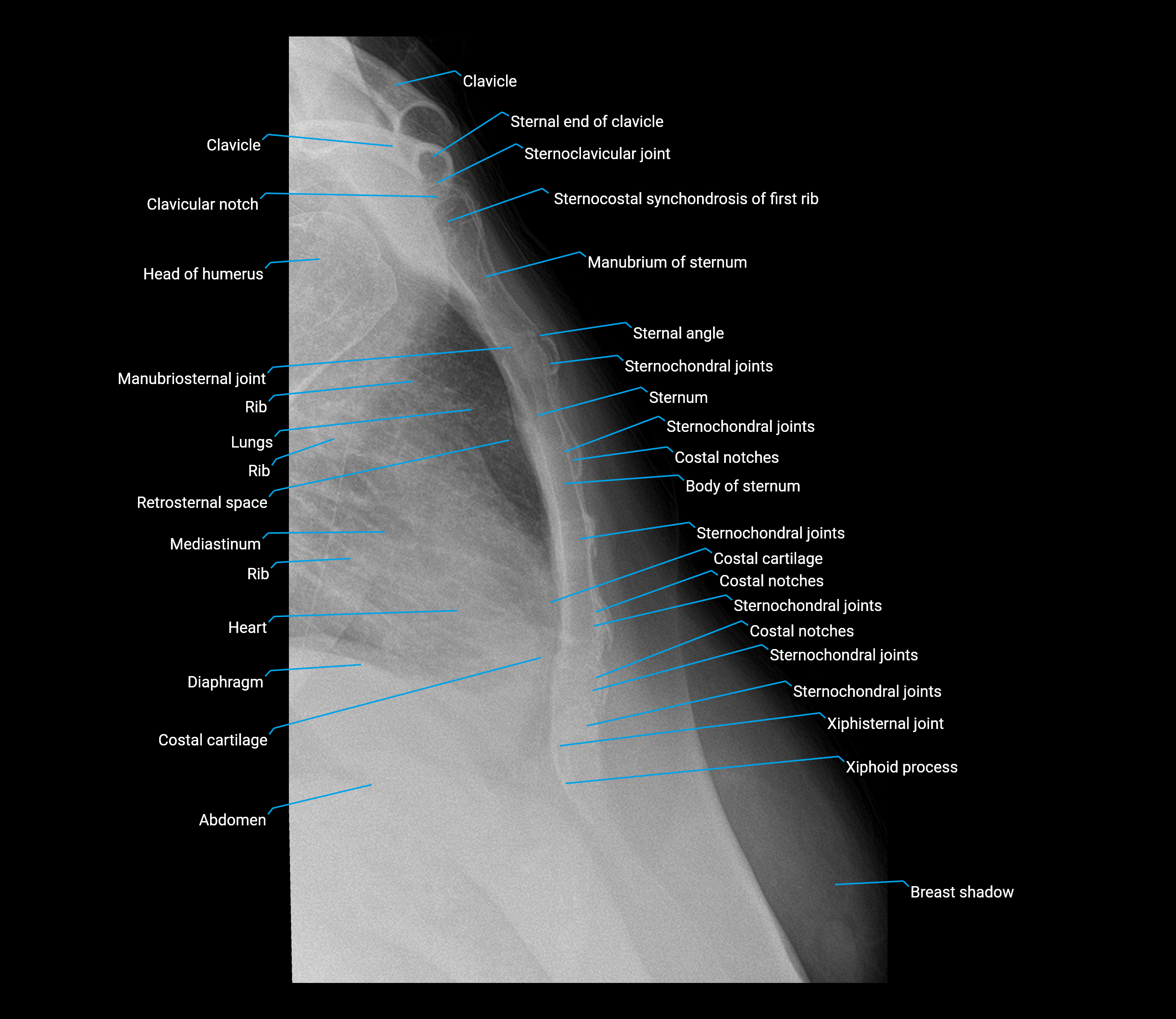 Sternum X-Ray Anatomy: Manubrium, Body, SC Joint & Xiphoid Labels