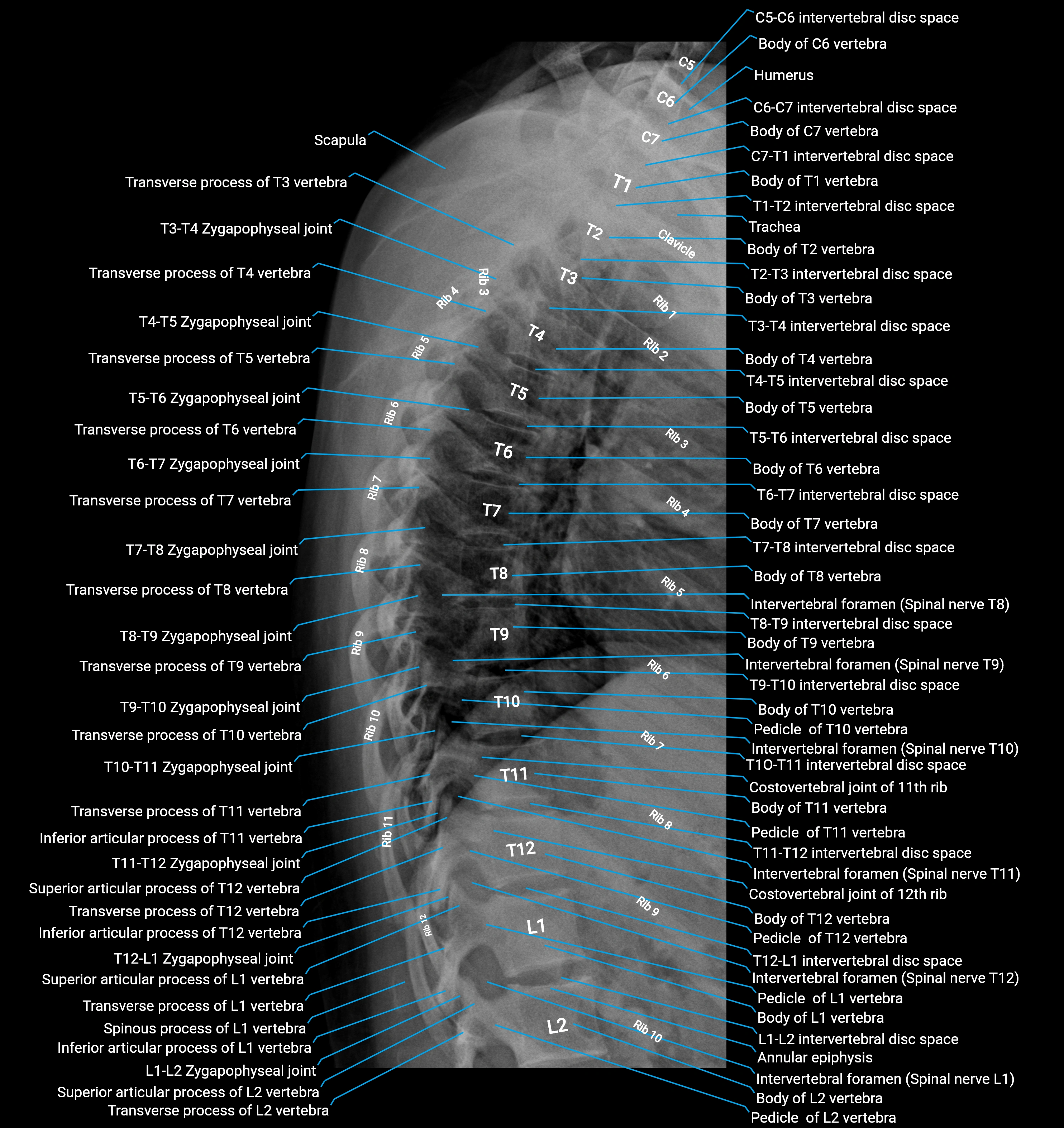 Thoracic Spine X-Ray Anatomy – AP & Lateral Views | Labeled Normal Images