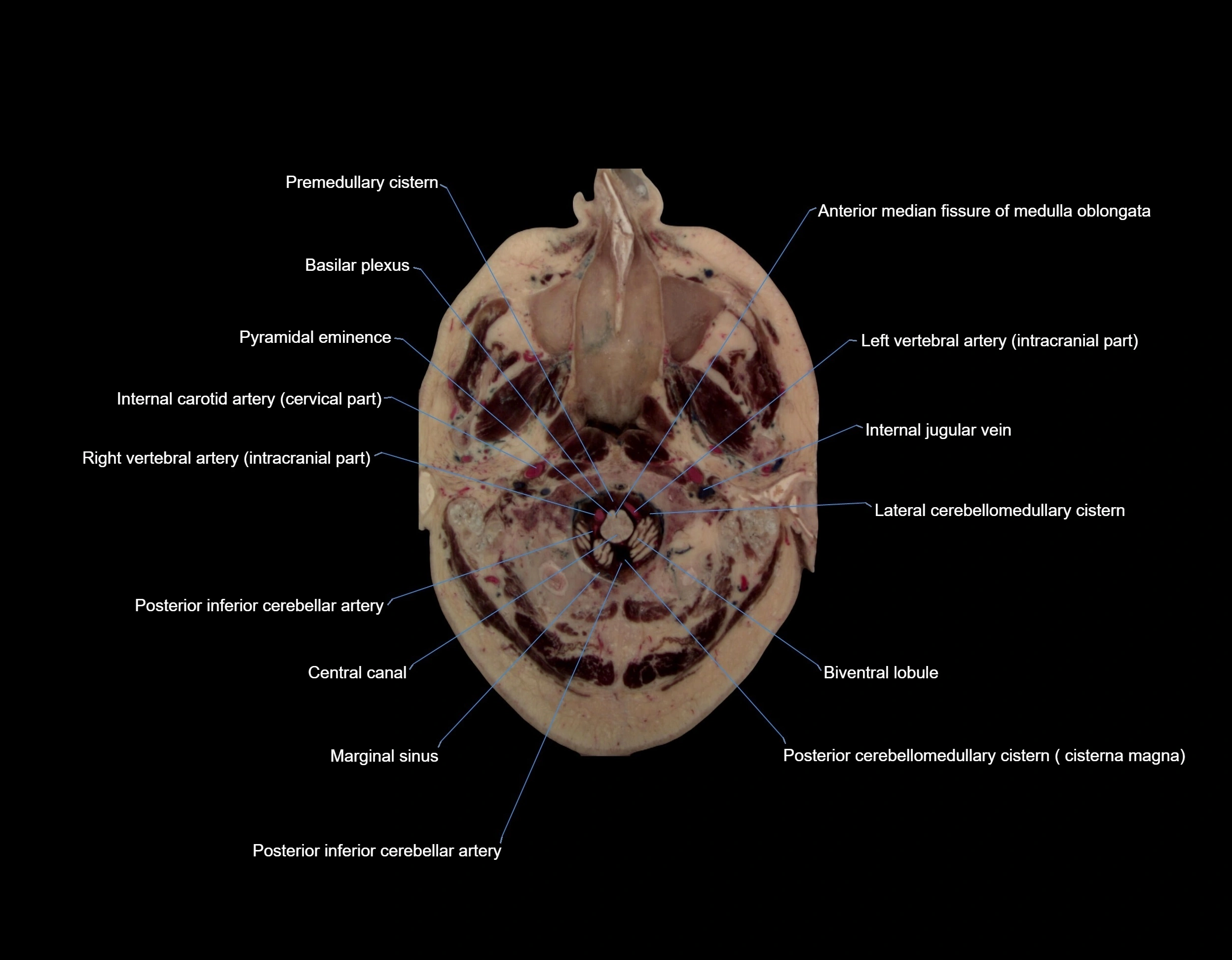 Visible-Human-Project-brain-Axial-cross-sectional-labelled-anatomy---img-00002.webp