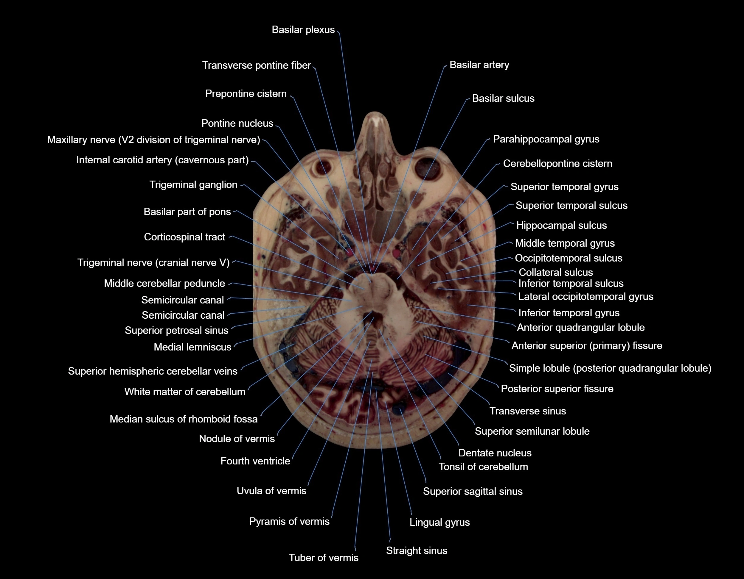 Visible-Human-Project-brain-Axial-cross-sectional-labelled-anatomy---img-000023.webp