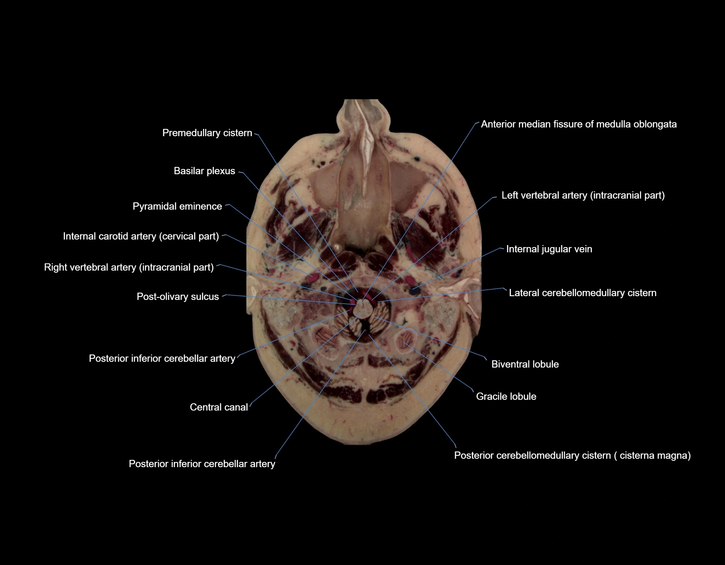 Visible-Human-Project-brain-Axial-cross-sectional-labelled-anatomy---img-00003.webp