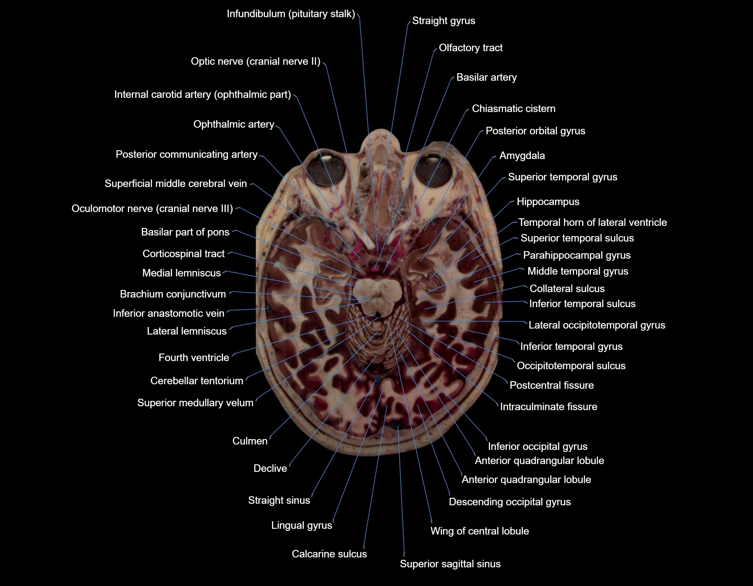 Visible-Human-Project-brain-Axial-cross-sectional-labelled-anatomy---img-000032.webp