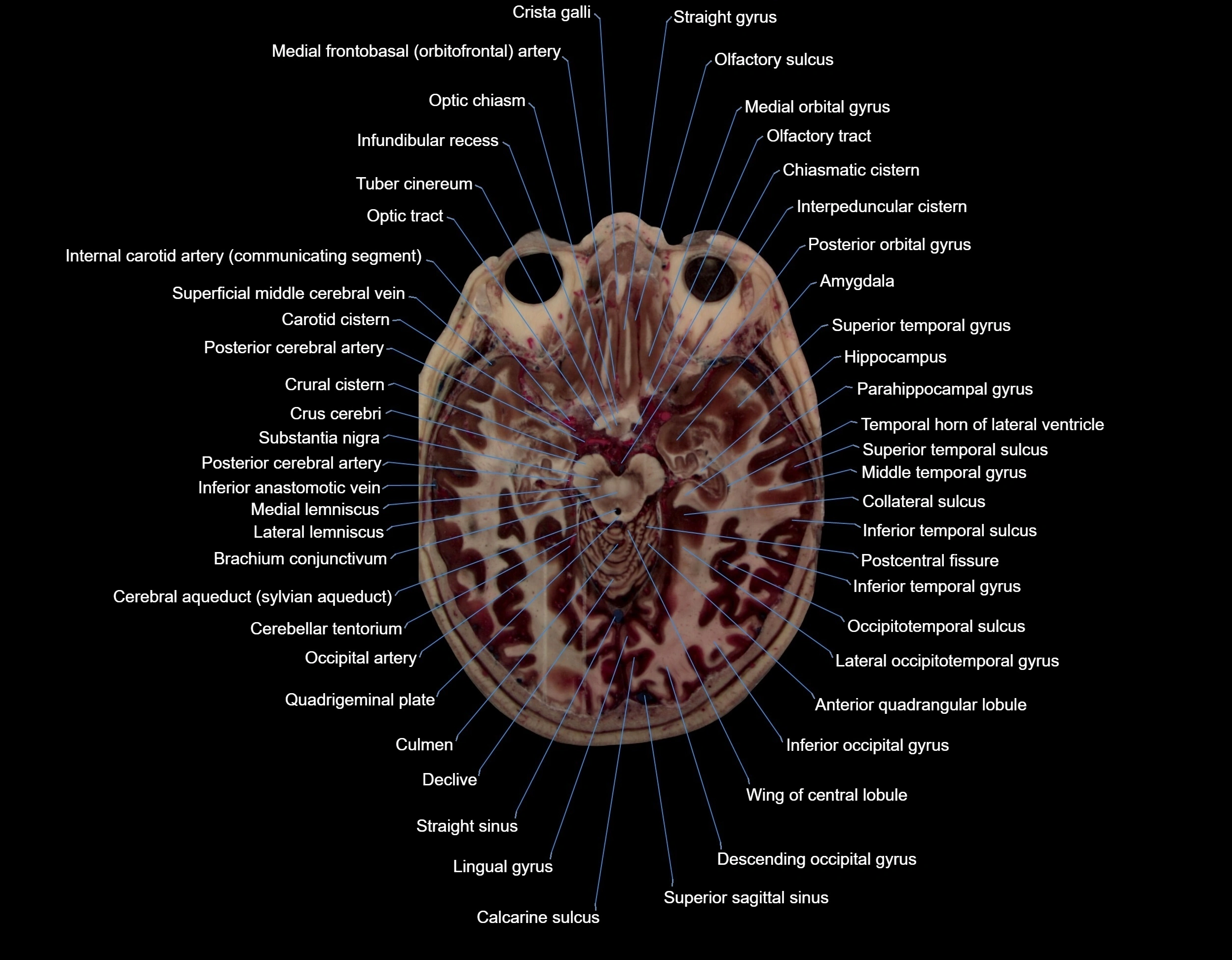 Visible-Human-Project-brain-Axial-cross-sectional-labelled-anatomy---img-000034.webp