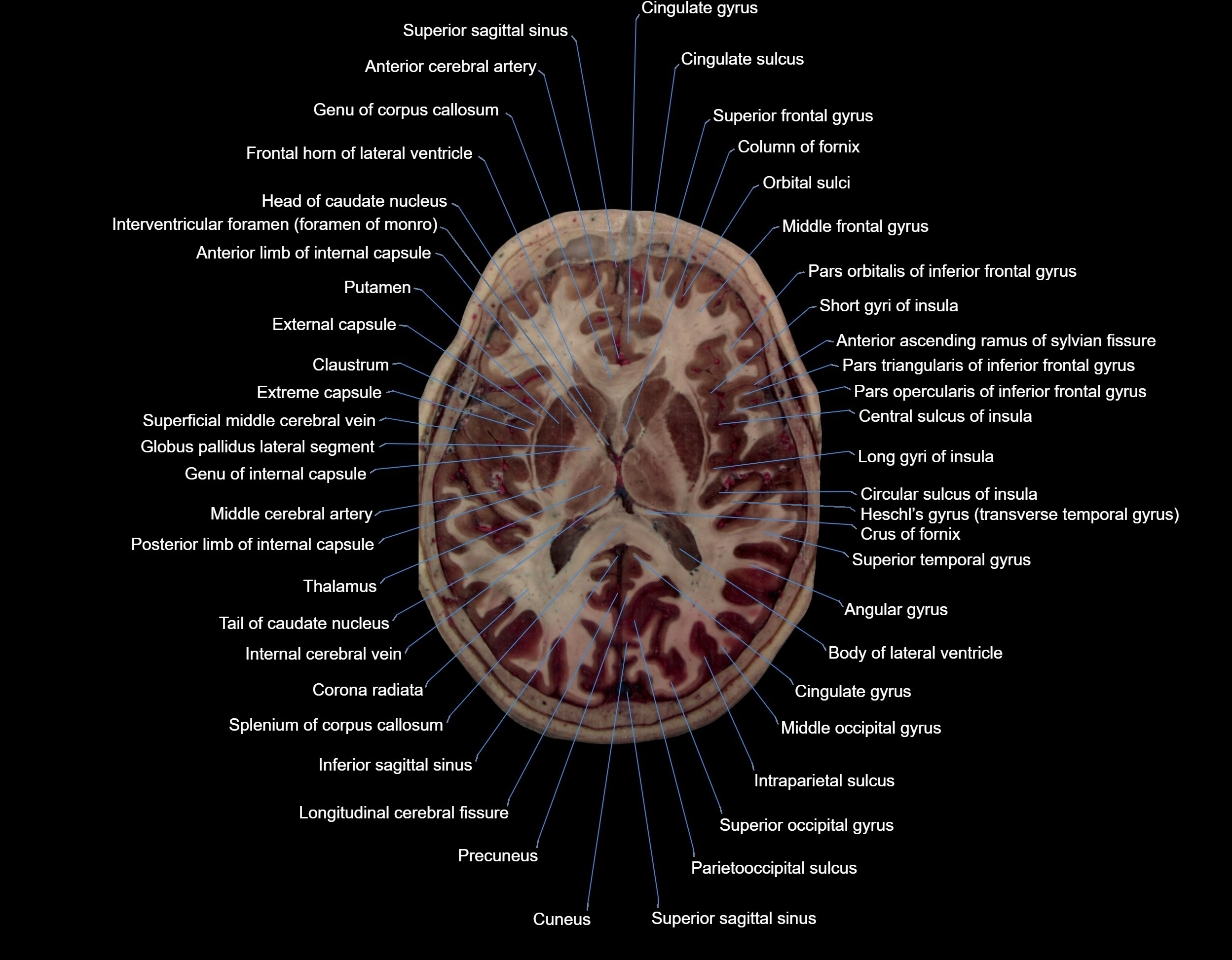Visible-Human-Project-brain-Axial-cross-sectional-labelled-anatomy---img-000045.webp