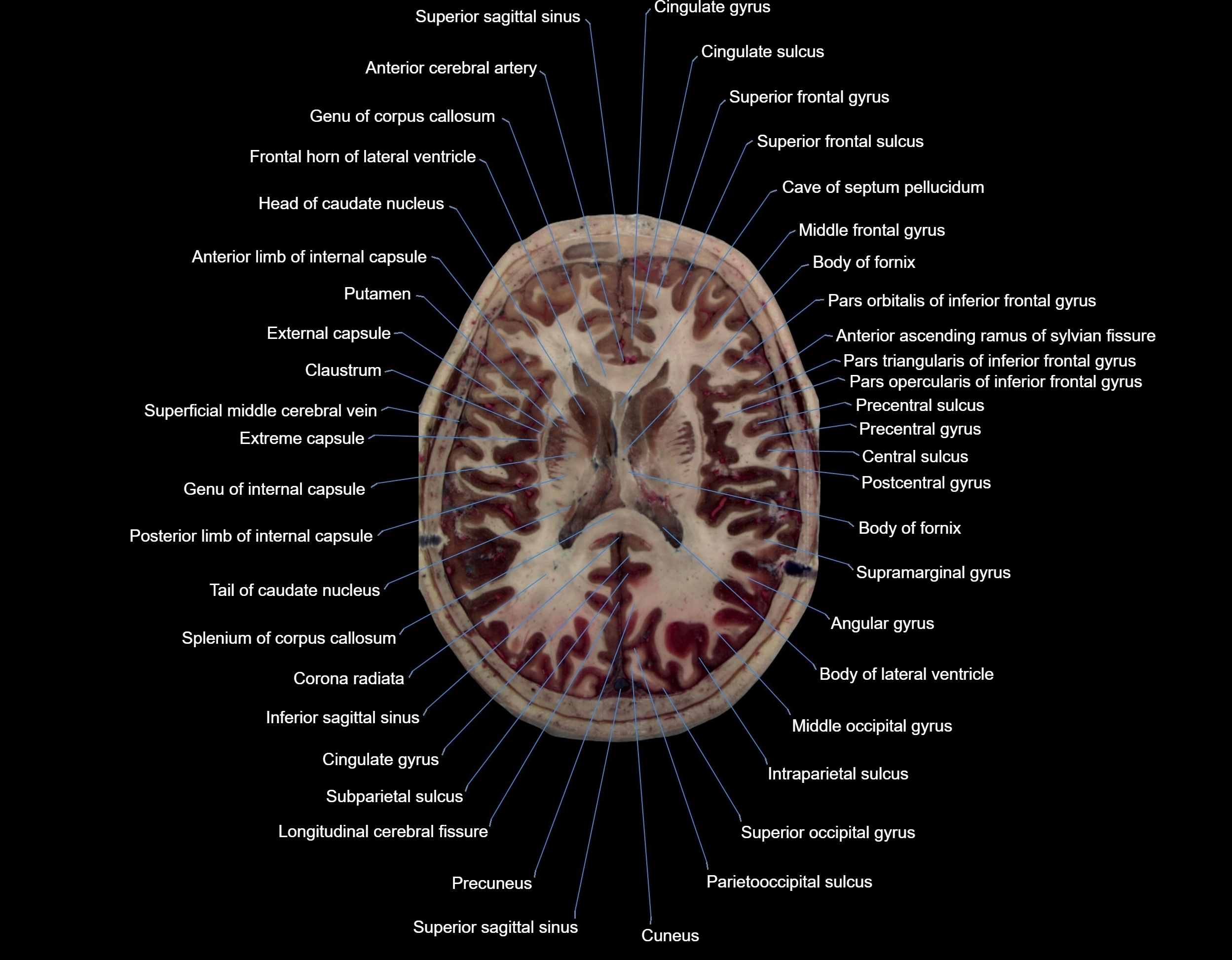 Visible-Human-Project-brain-Axial-cross-sectional-labelled-anatomy---img-000048.webp