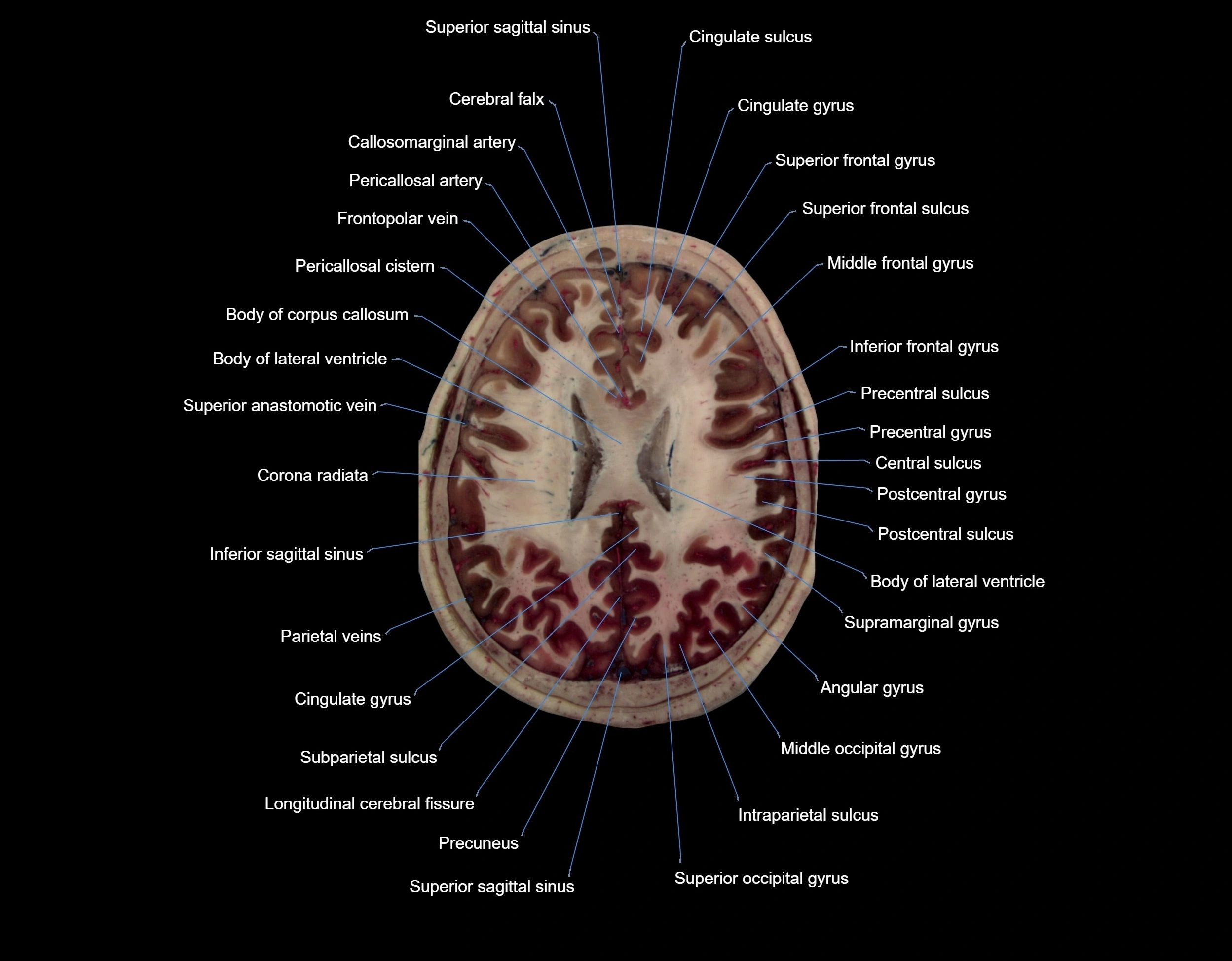 Visible-Human-Project-brain-Axial-cross-sectional-labelled-anatomy---img-000053.webp