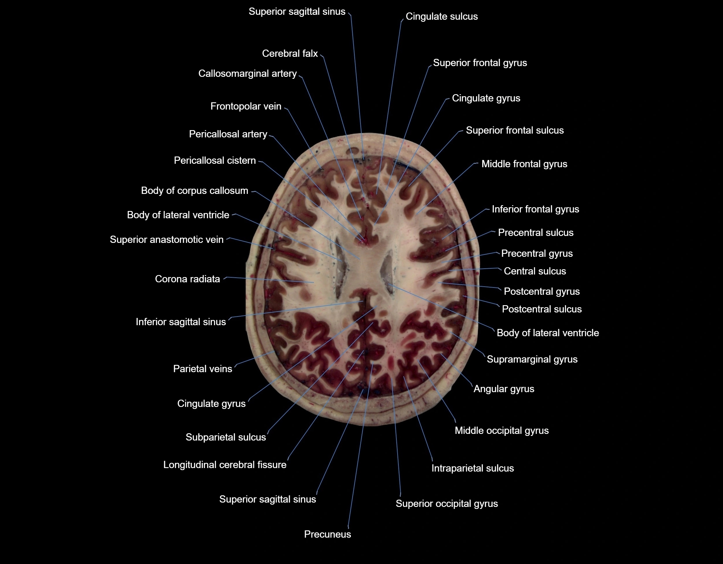 Visible-Human-Project-brain-Axial-cross-sectional-labelled-anatomy---img-000054.webp
