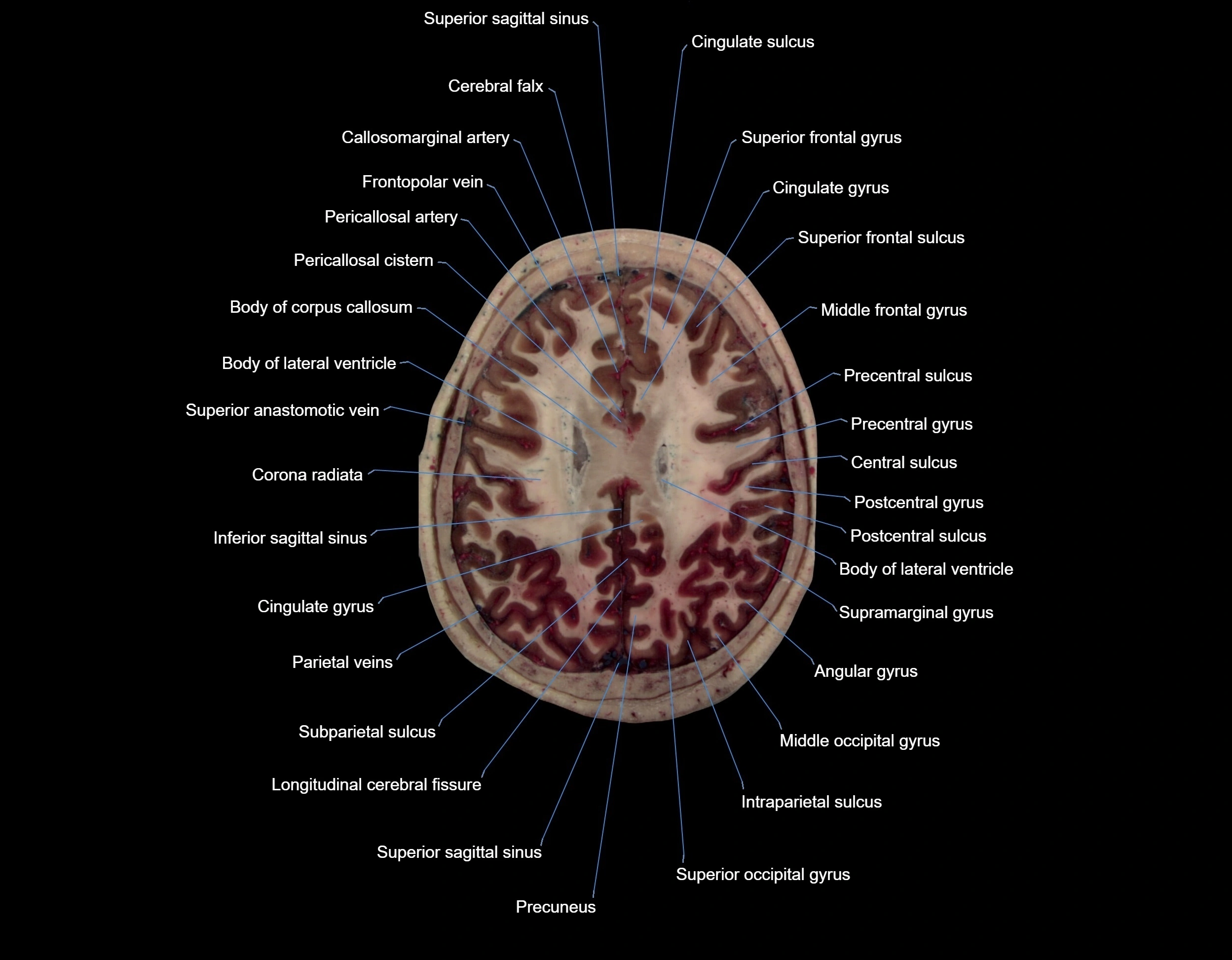 Visible-Human-Project-brain-Axial-cross-sectional-labelled-anatomy---img-000055.webp