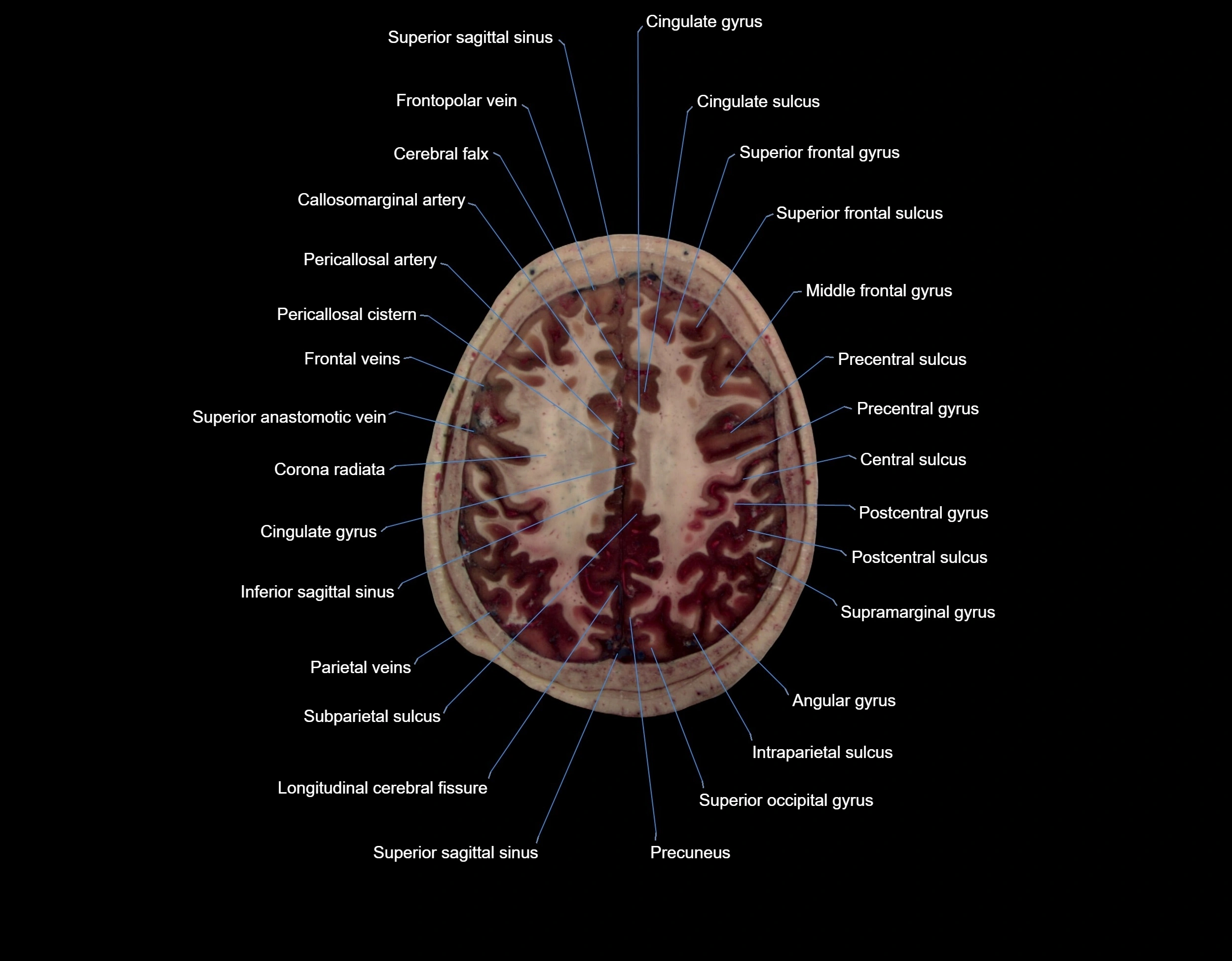 Visible-Human-Project-brain-Axial-cross-sectional-labelled-anatomy---img-000059.webp